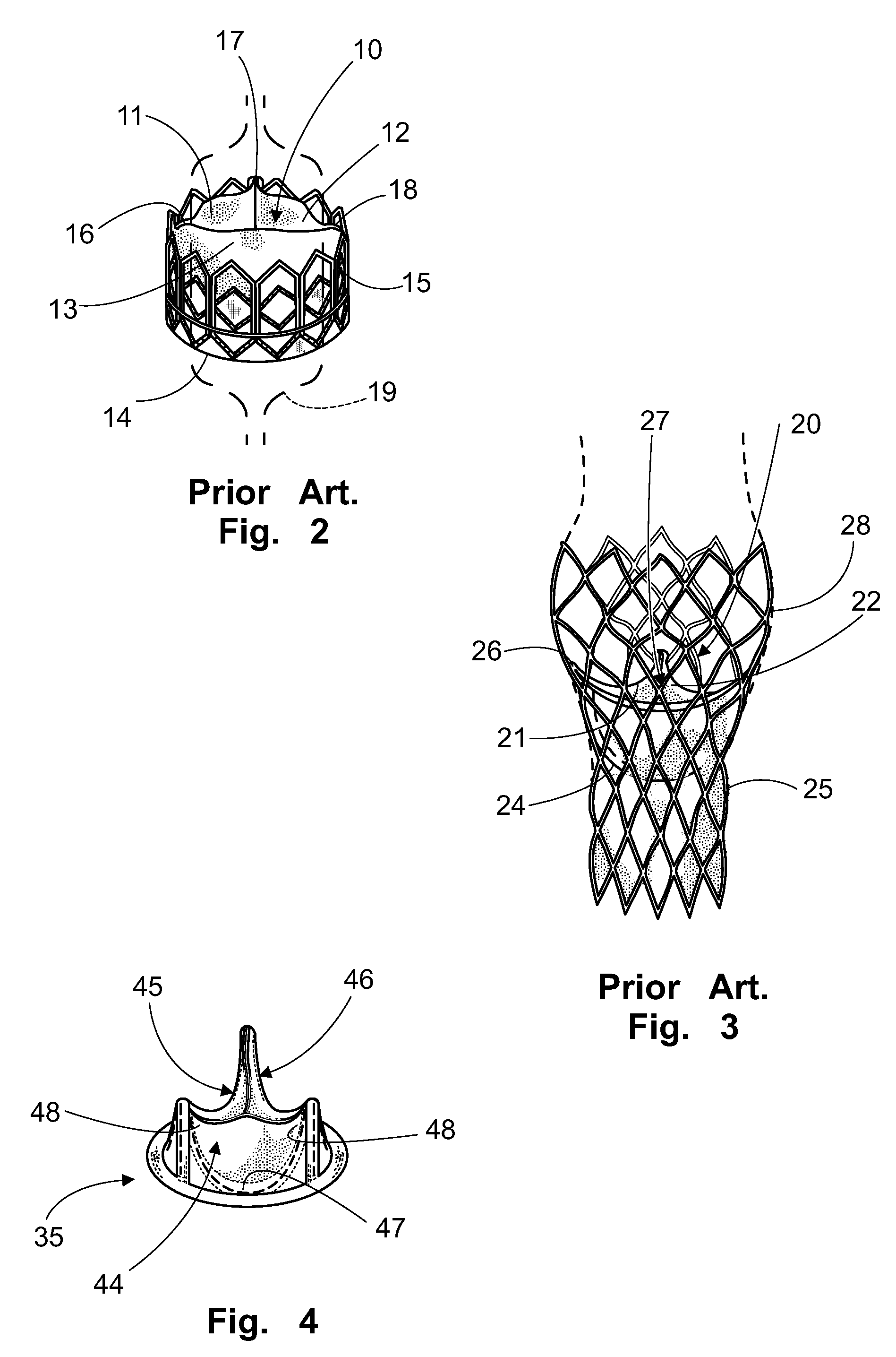 Prosthetic valve for intraluminal implantation