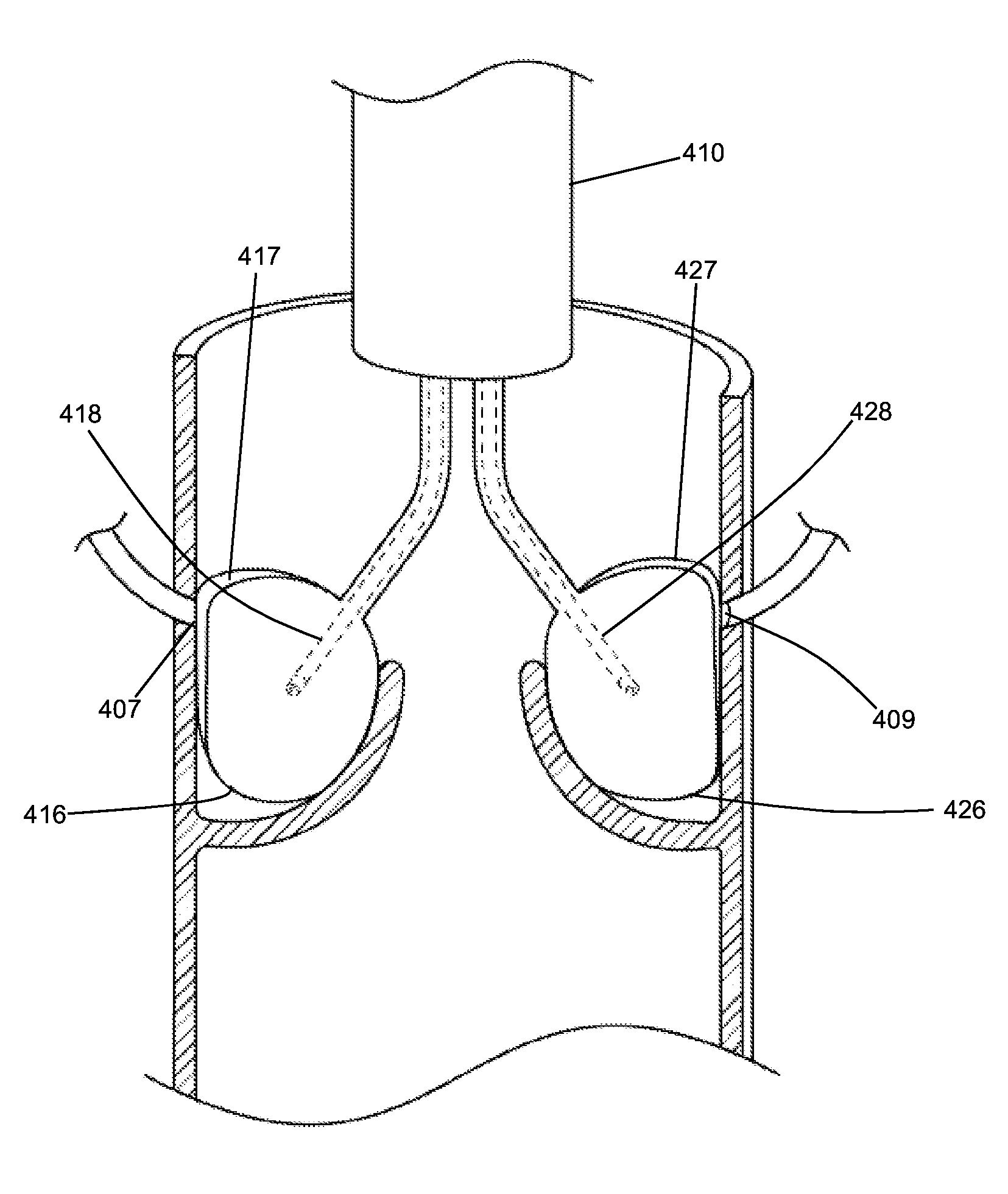 Shockwave valvuloplasty with multiple balloons