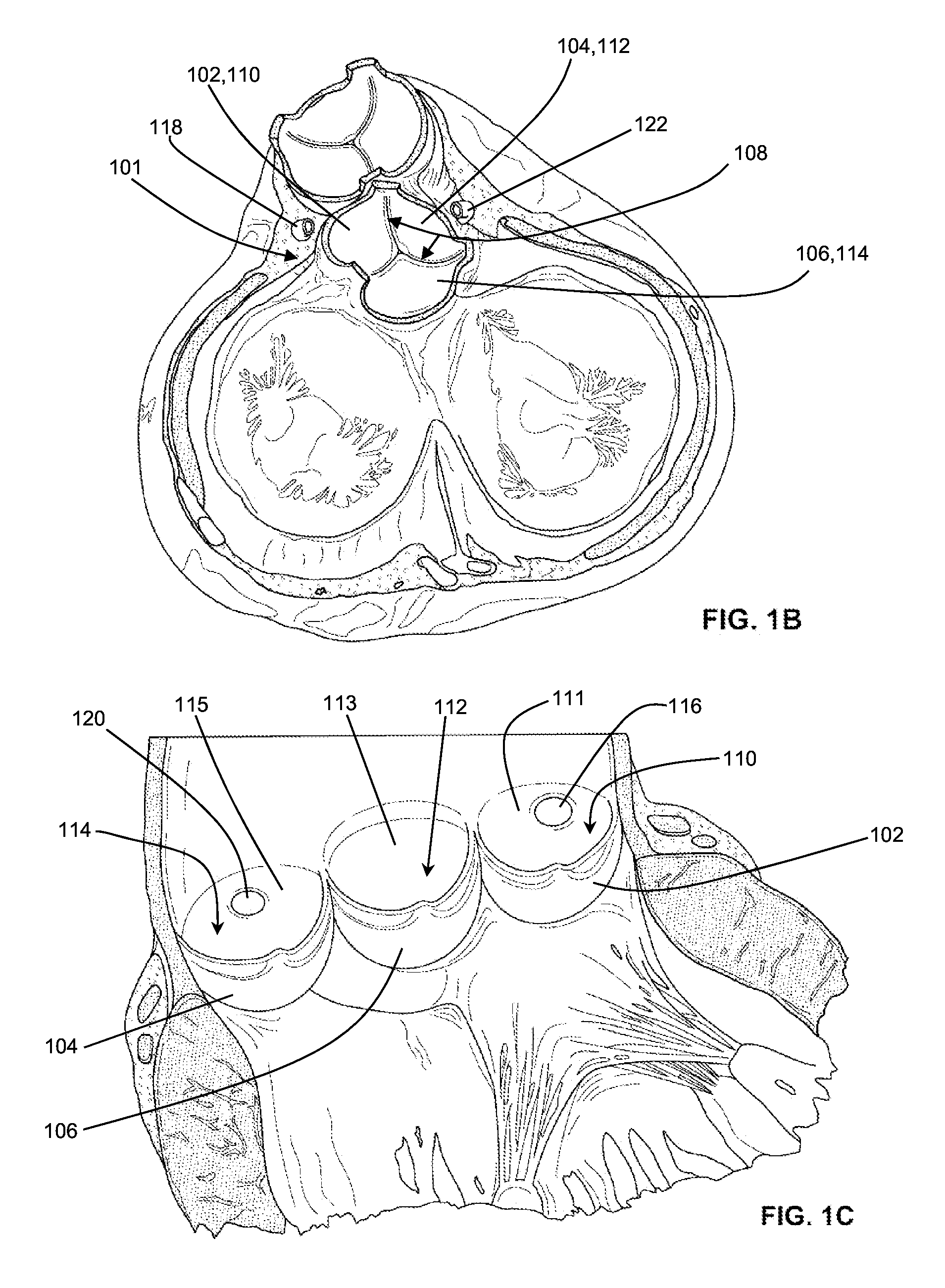 Shockwave valvuloplasty with multiple balloons