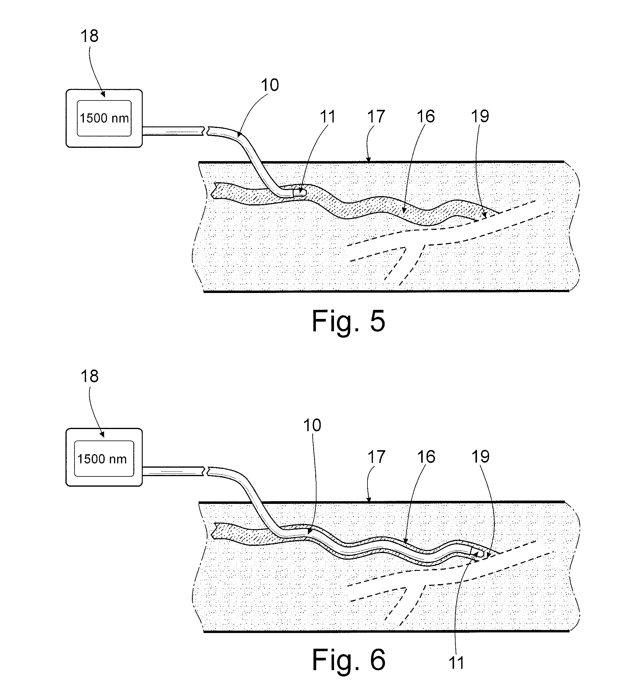 Method of endovenous laser treatment of varicose veins