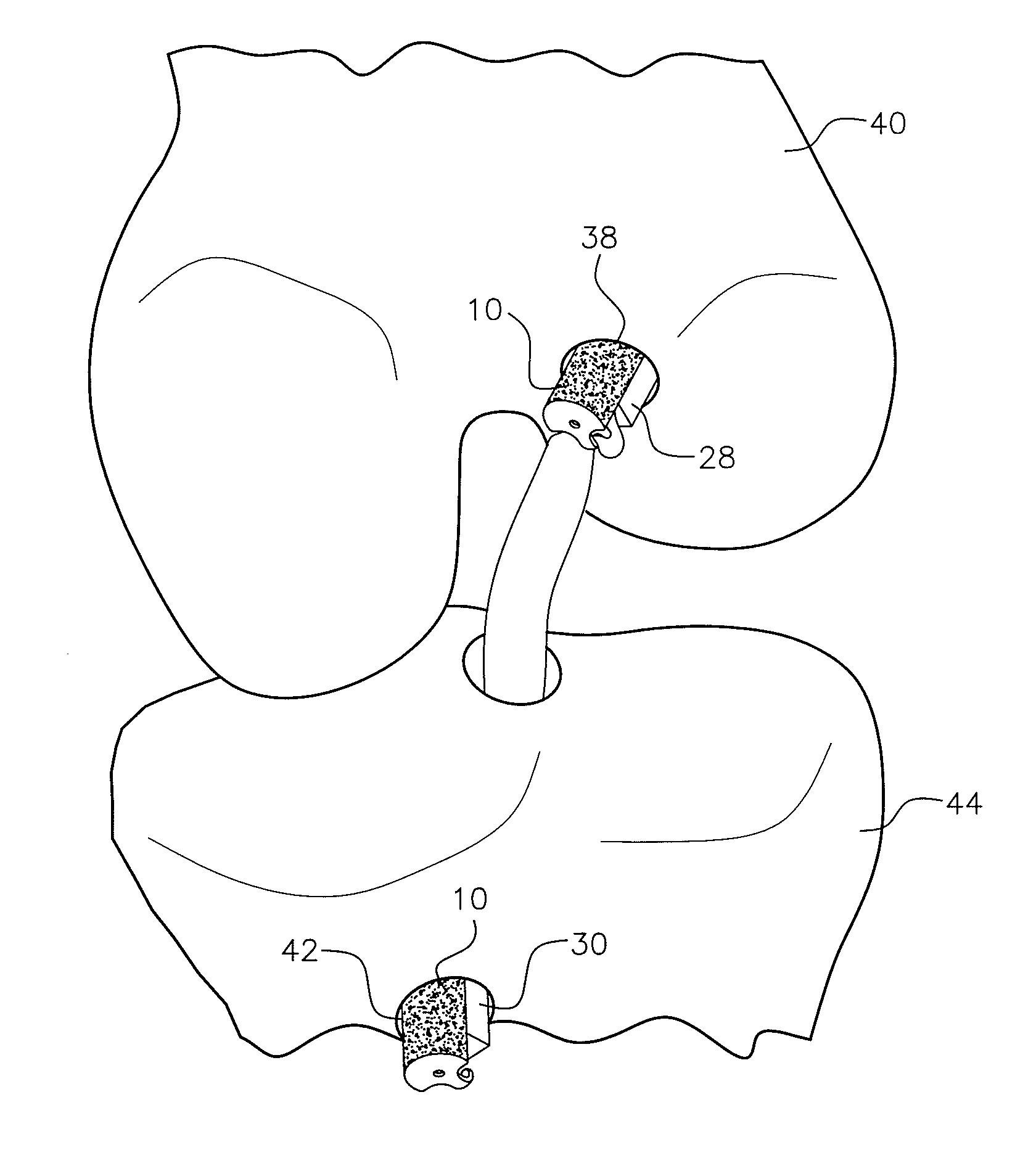 Interference wedge for securing an anterior cruciate ligament graft in a bone tunnel