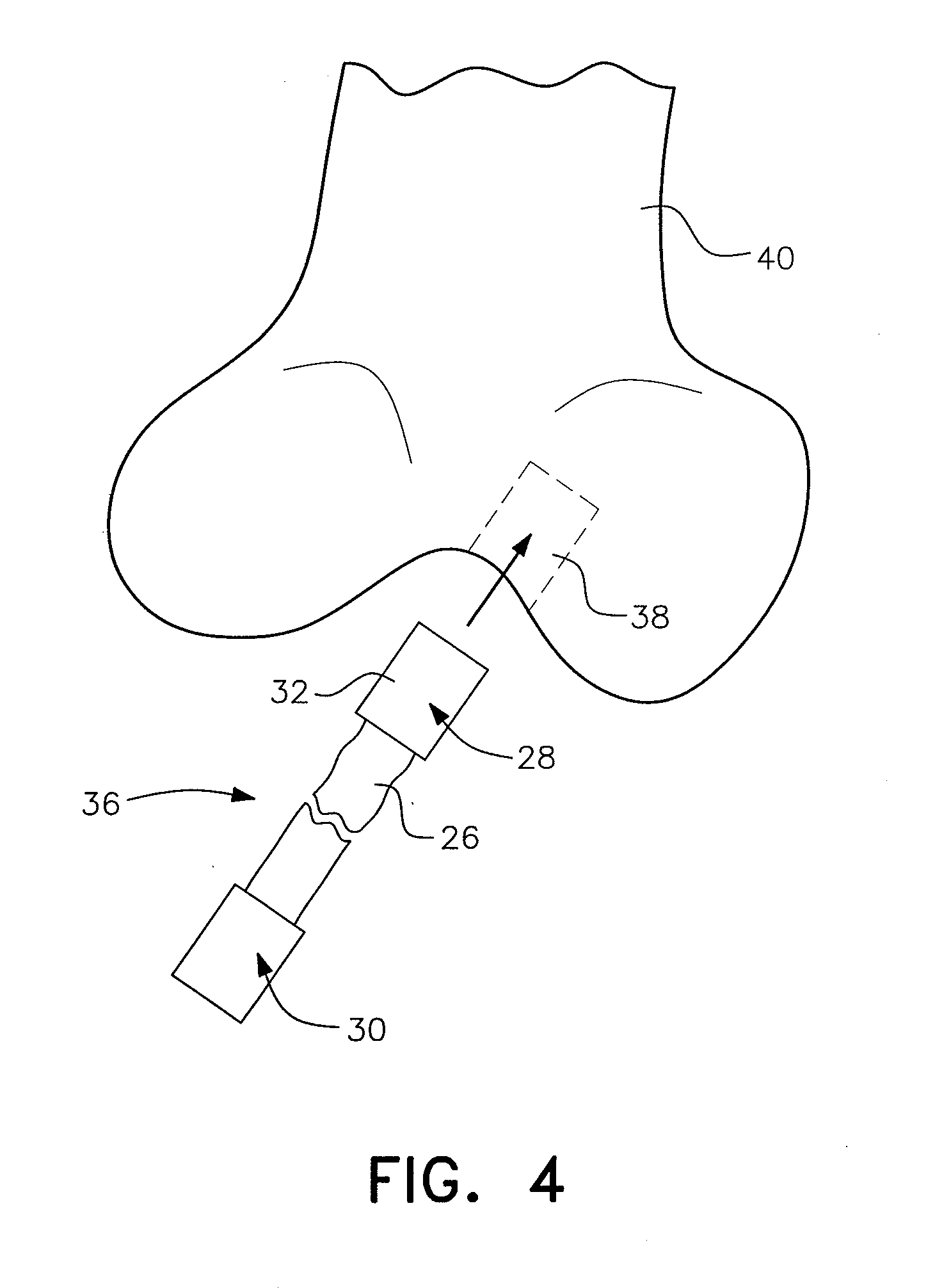 Interference wedge for securing an anterior cruciate ligament graft in a bone tunnel