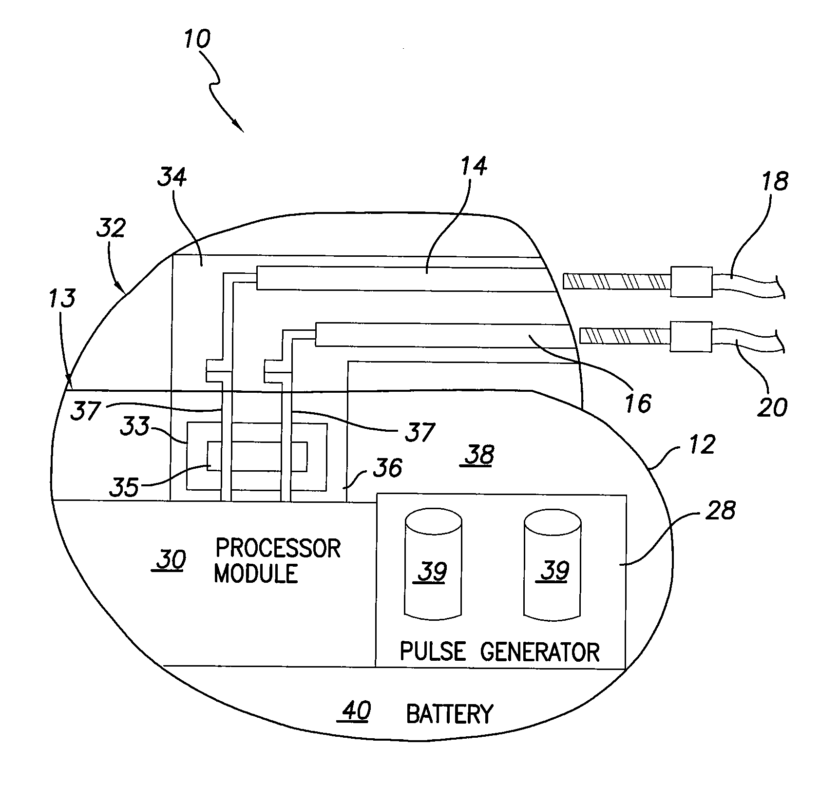 Implantable medical device with improved EMI filter