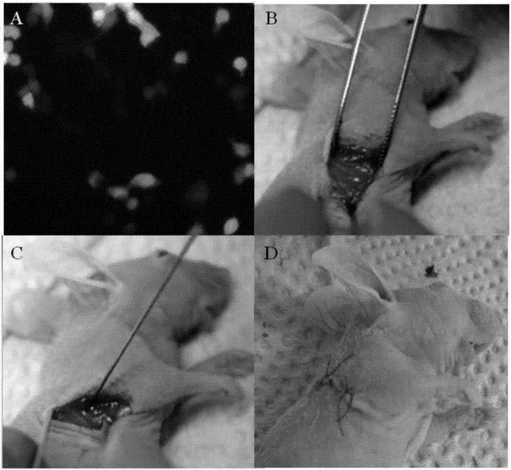 Application of EMT (epithelial to meschymal transition) circulating tumor stem cells in lung cancer proliferation, drug resistance and transfer diseases