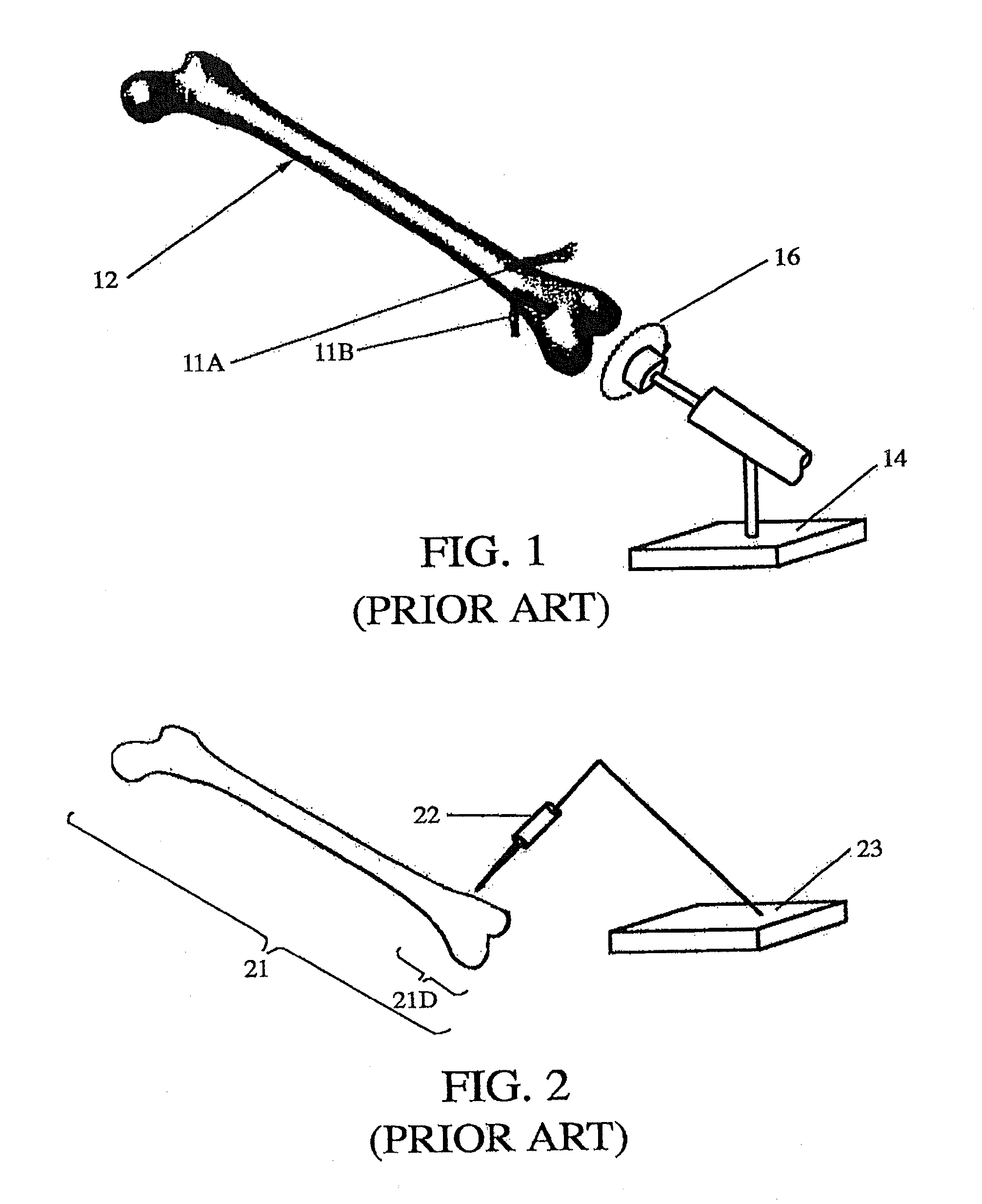 Total joint arthroplasty system