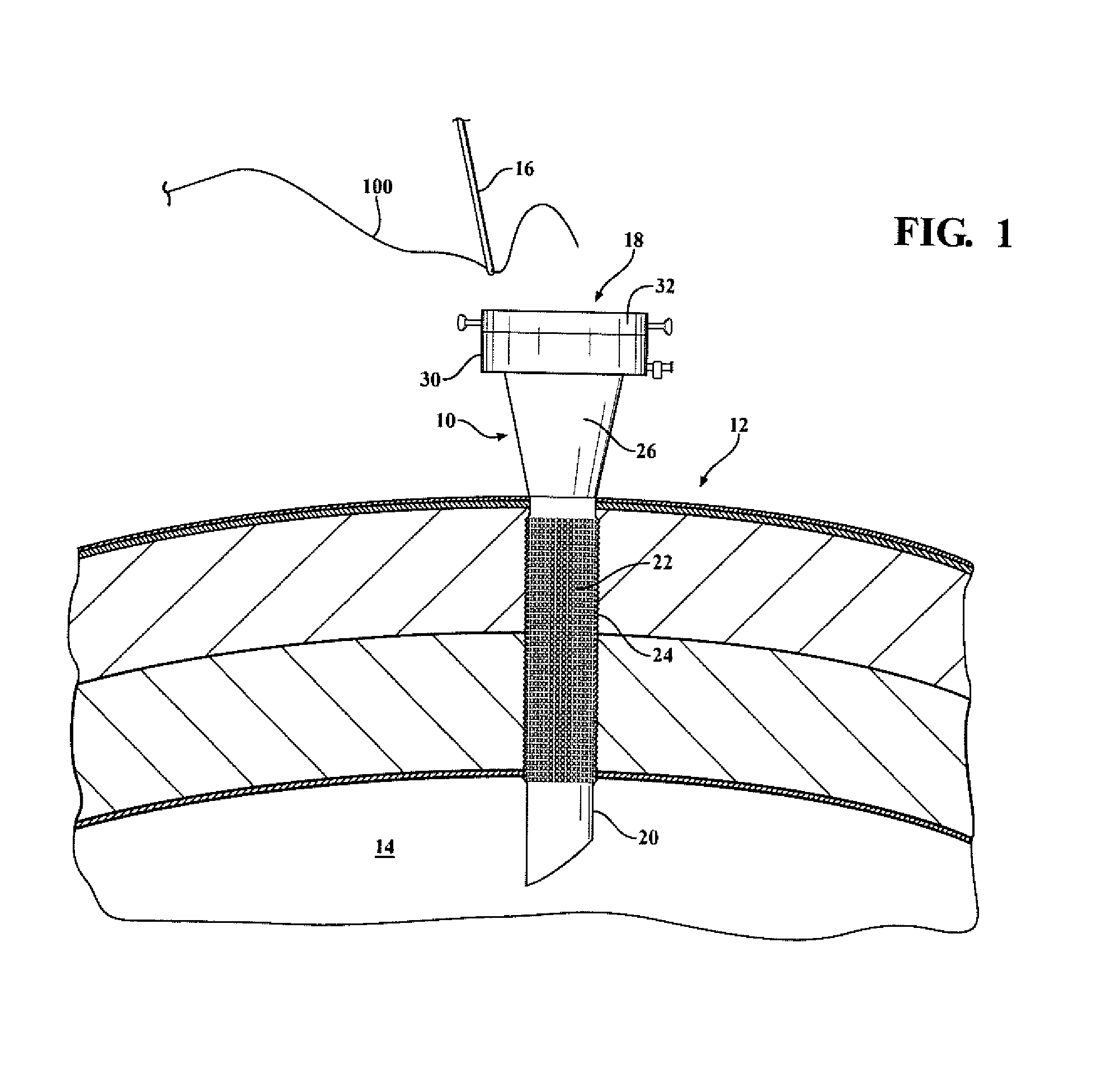 Laparoscopic cannula with suturing capability