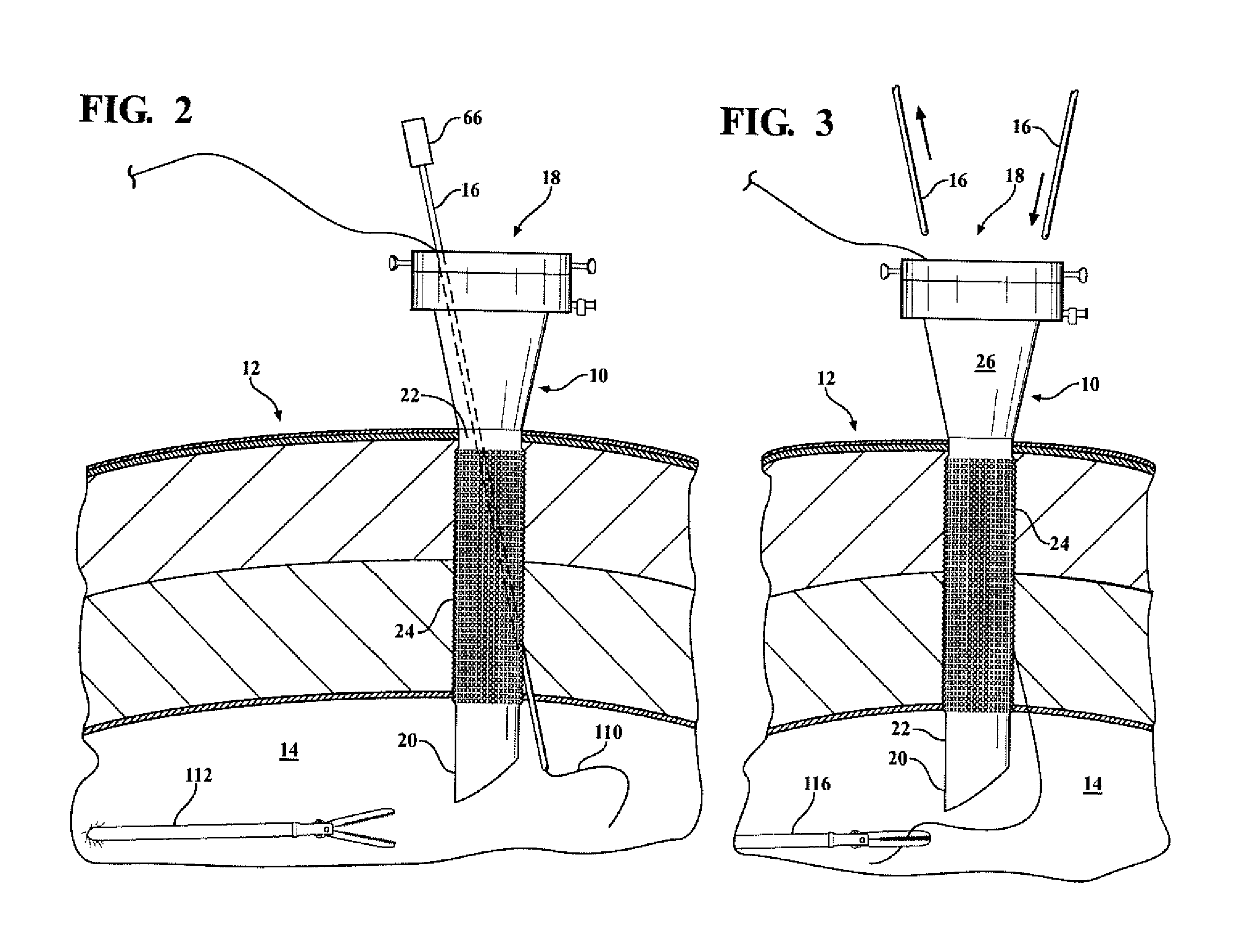 Laparoscopic cannula with suturing capability