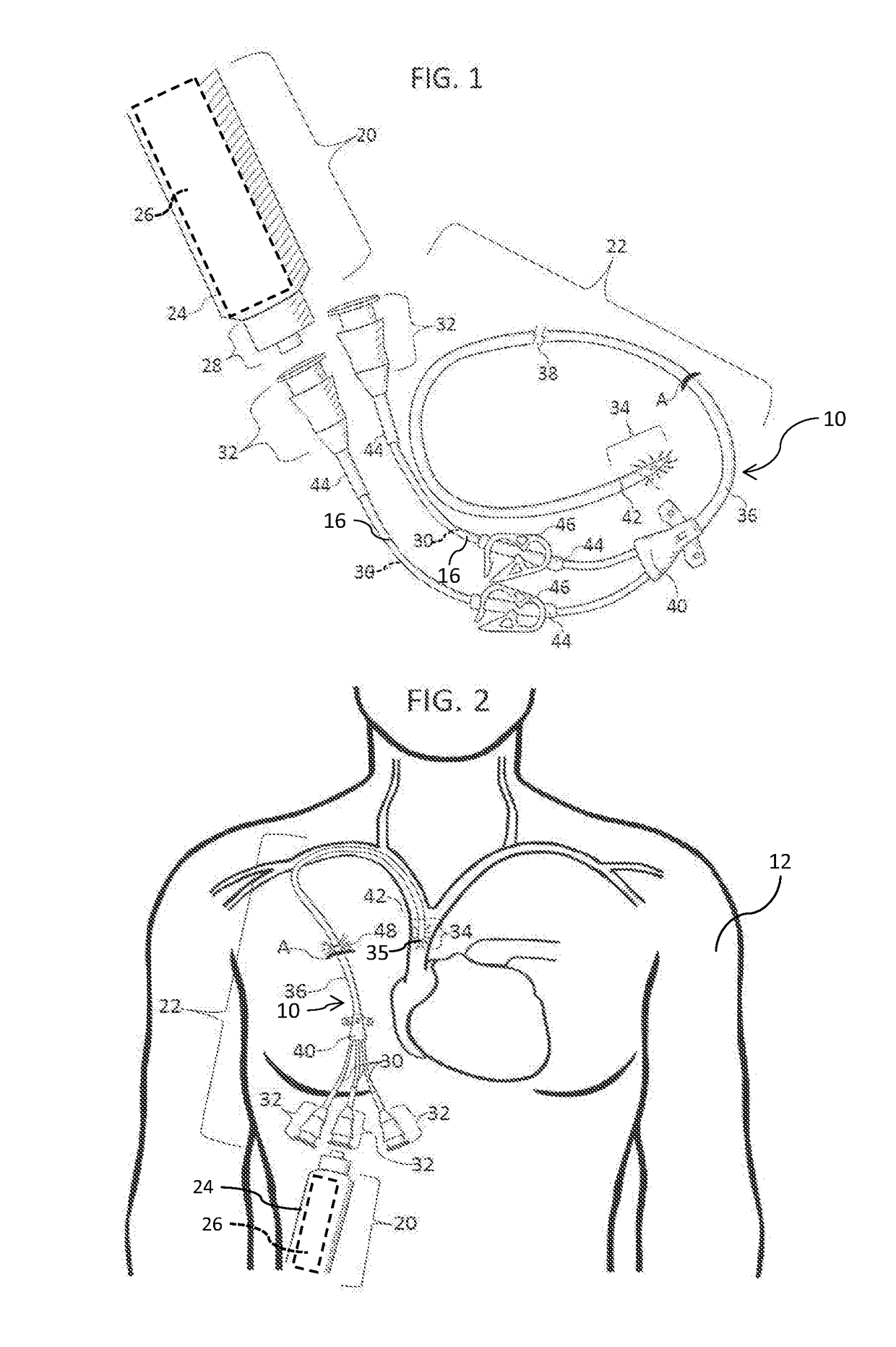 Methods and apparatus to deliver therapeutic, non-ultraviolet electromagnetic radiation to inactivate infectious agents and/or to enhance healthy cell growth via a catheter residing in a body cavity