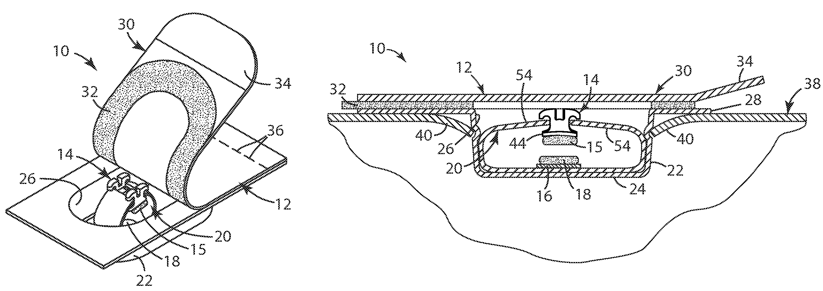 Packaged orthodontic appliance and adhesive material