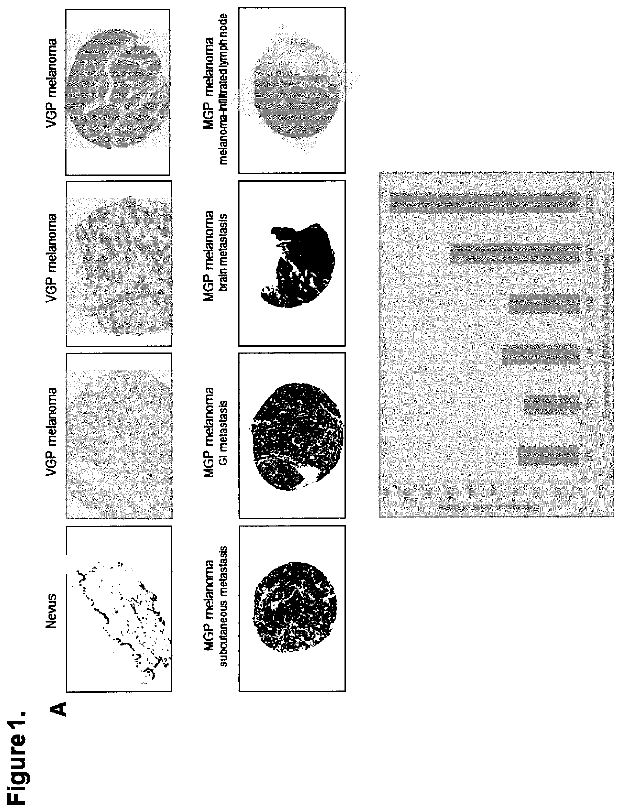 Phenyl-heterocycle-phenyl derivatives for use in the treatment or prevention of melanoma