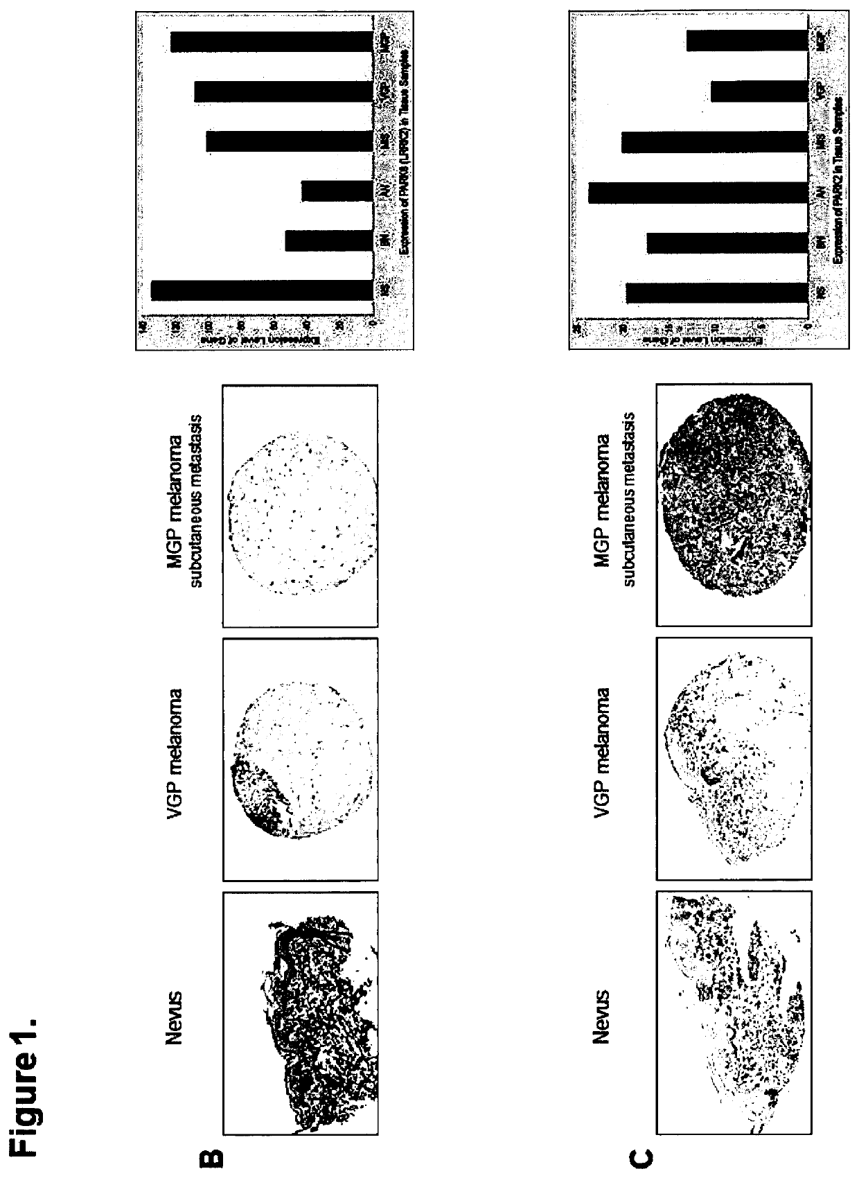 Phenyl-heterocycle-phenyl derivatives for use in the treatment or prevention of melanoma