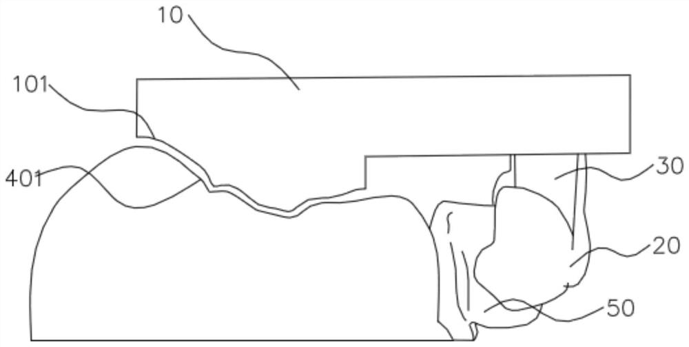 Orthodontic auxiliary bonding guide plate