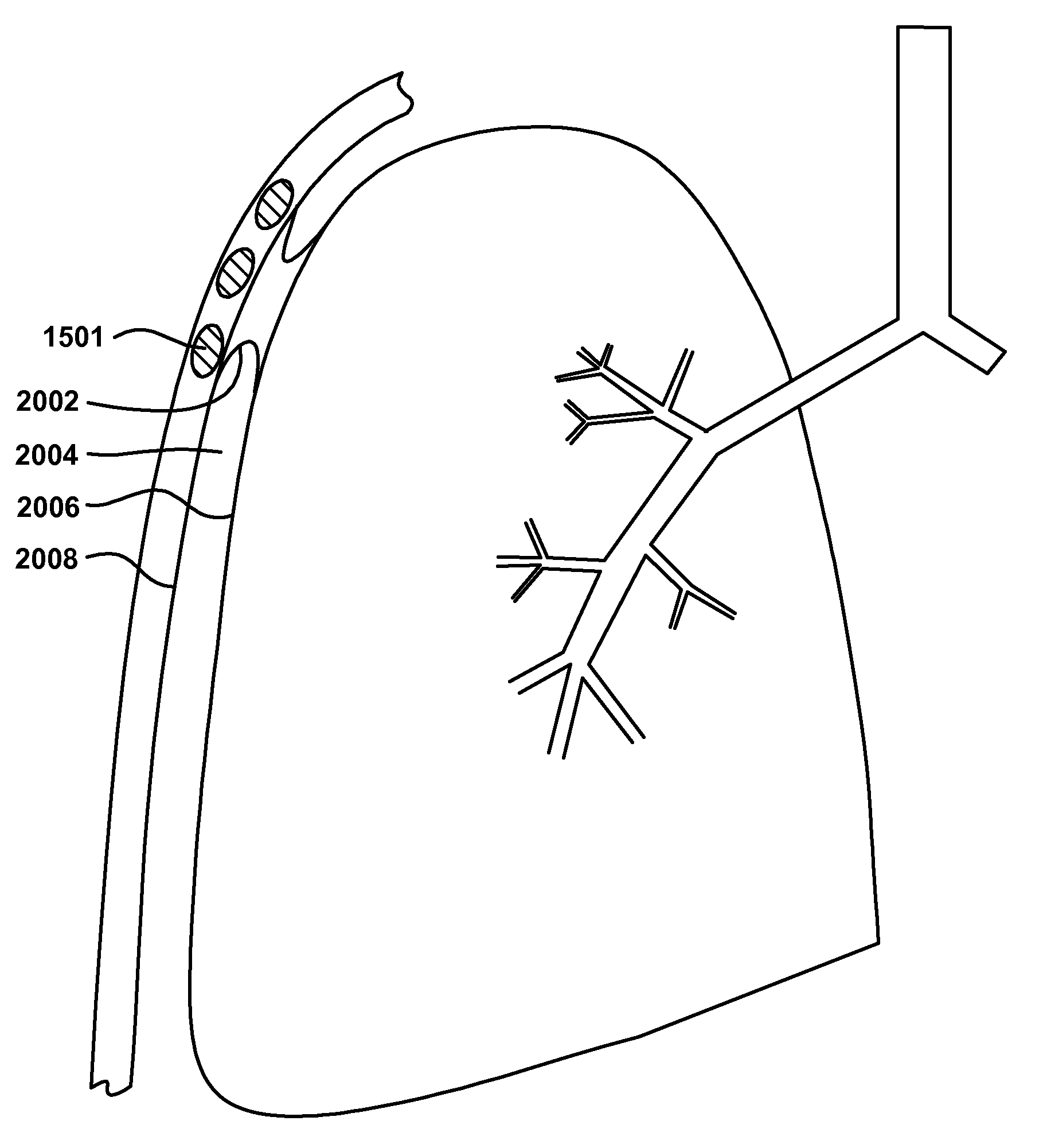 Variable parietal/visceral pleural coupling