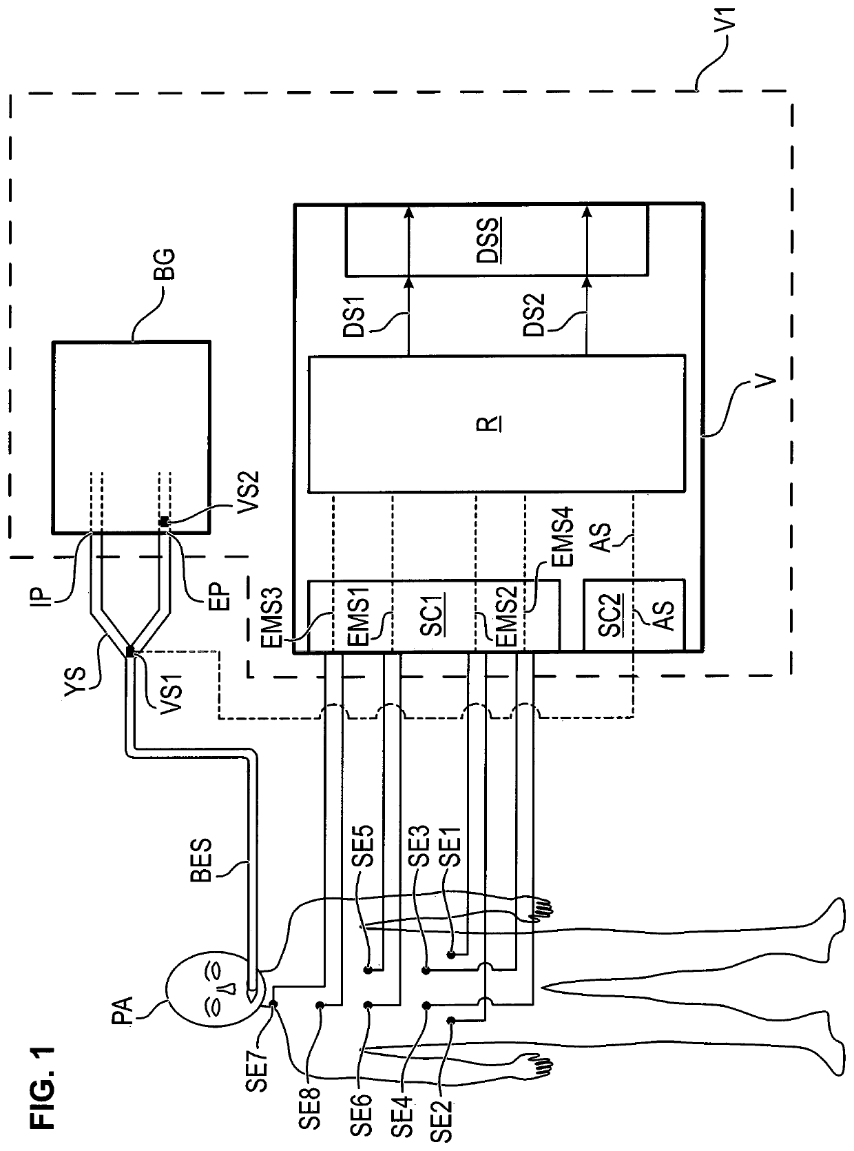 Device and process for providing data signals indicating muscle activities that are relevant for inspiratory as well as expiratory breathing efforts of a patient