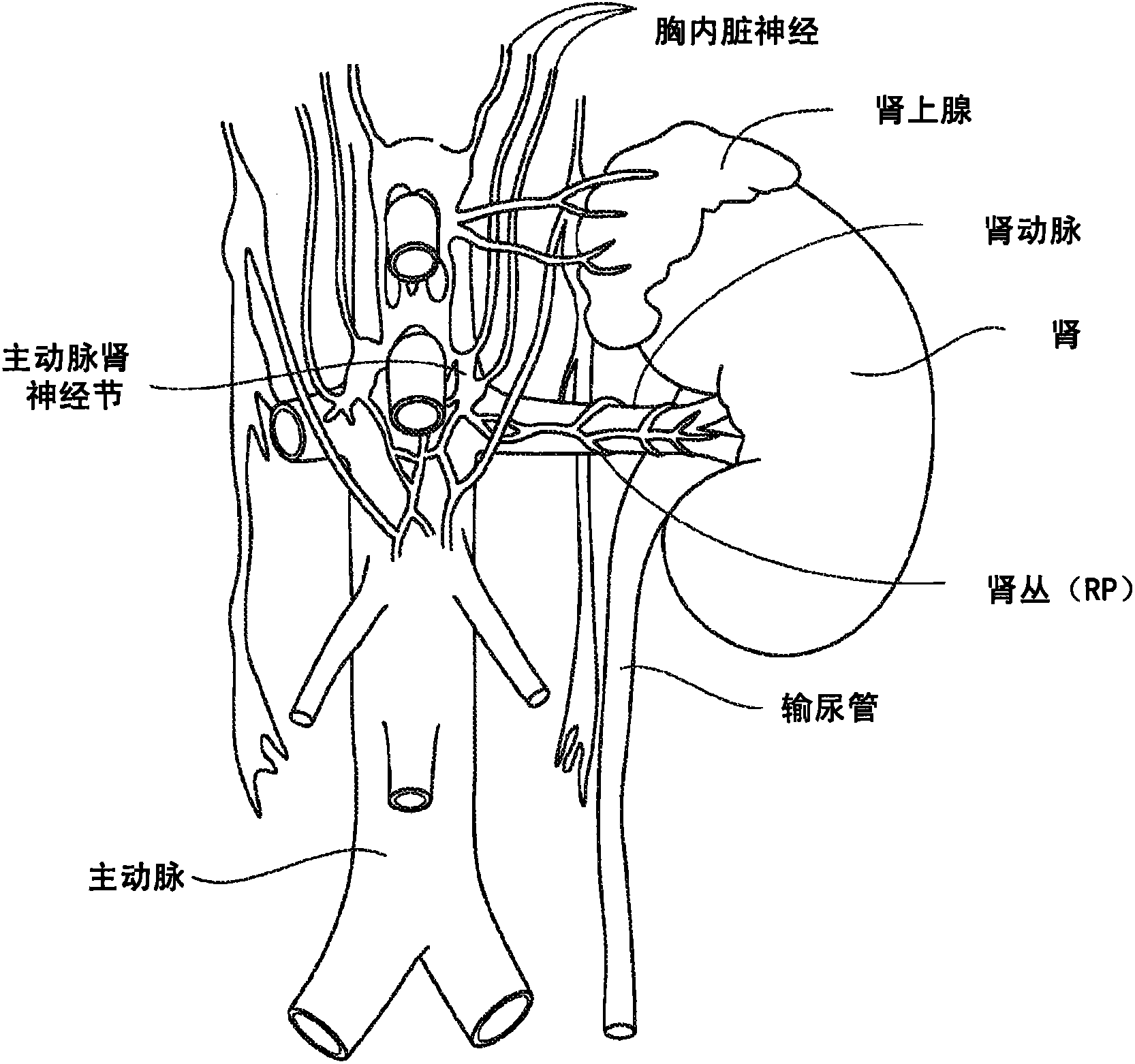 Apparatus, systems and methods for achieving intravascular, thermally-induced renal neuromodulation