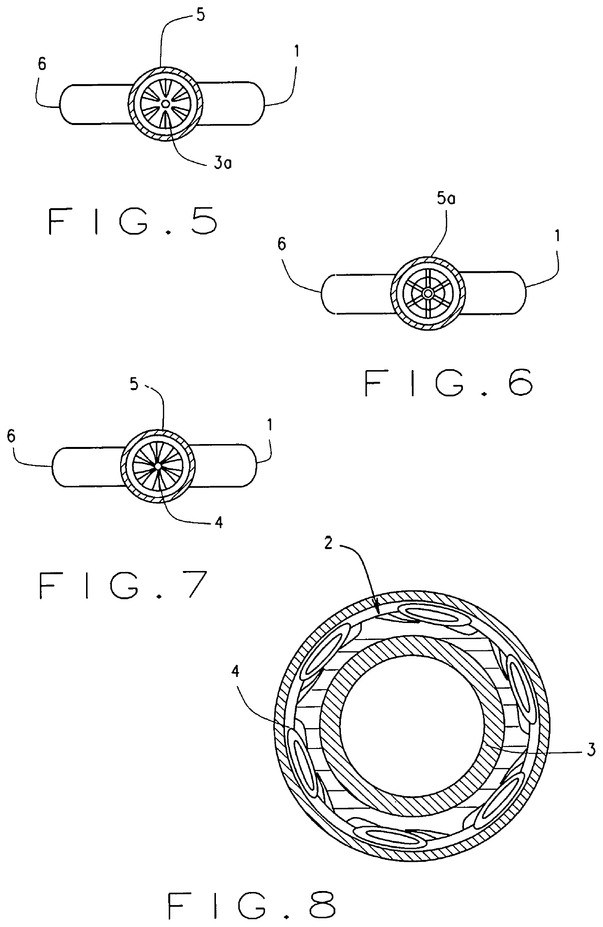 Expandable intra-venous catheter for a faster intra-venous fluid challenge