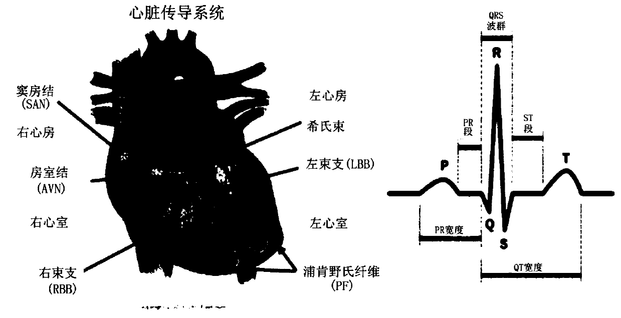 Device for placing, in his bundle, pacemaker lead tip having passed through coronary sinus