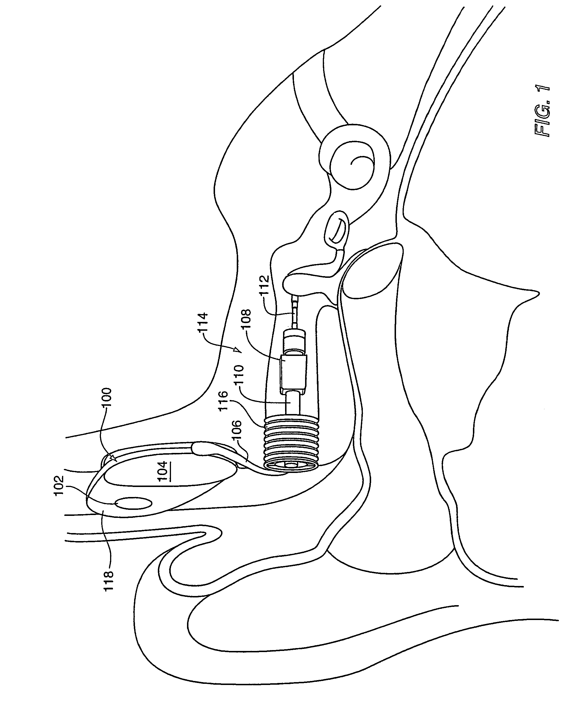 Method and system for external assessment of hearing aids that include implanted actuators