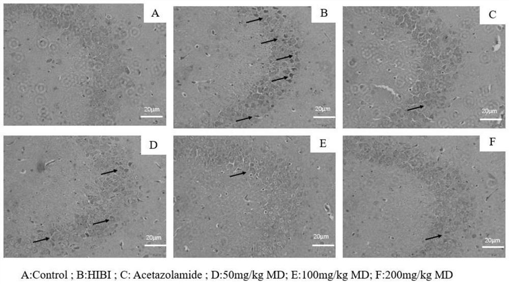 Meldonium as the application and medicine for preventing or treating acute brain injury at high altitude