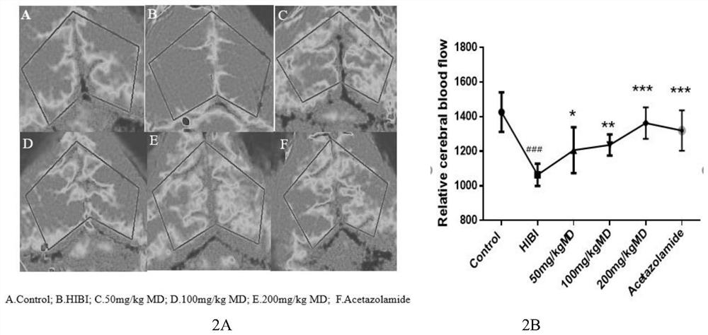 Meldonium as the application and medicine for preventing or treating acute brain injury at high altitude