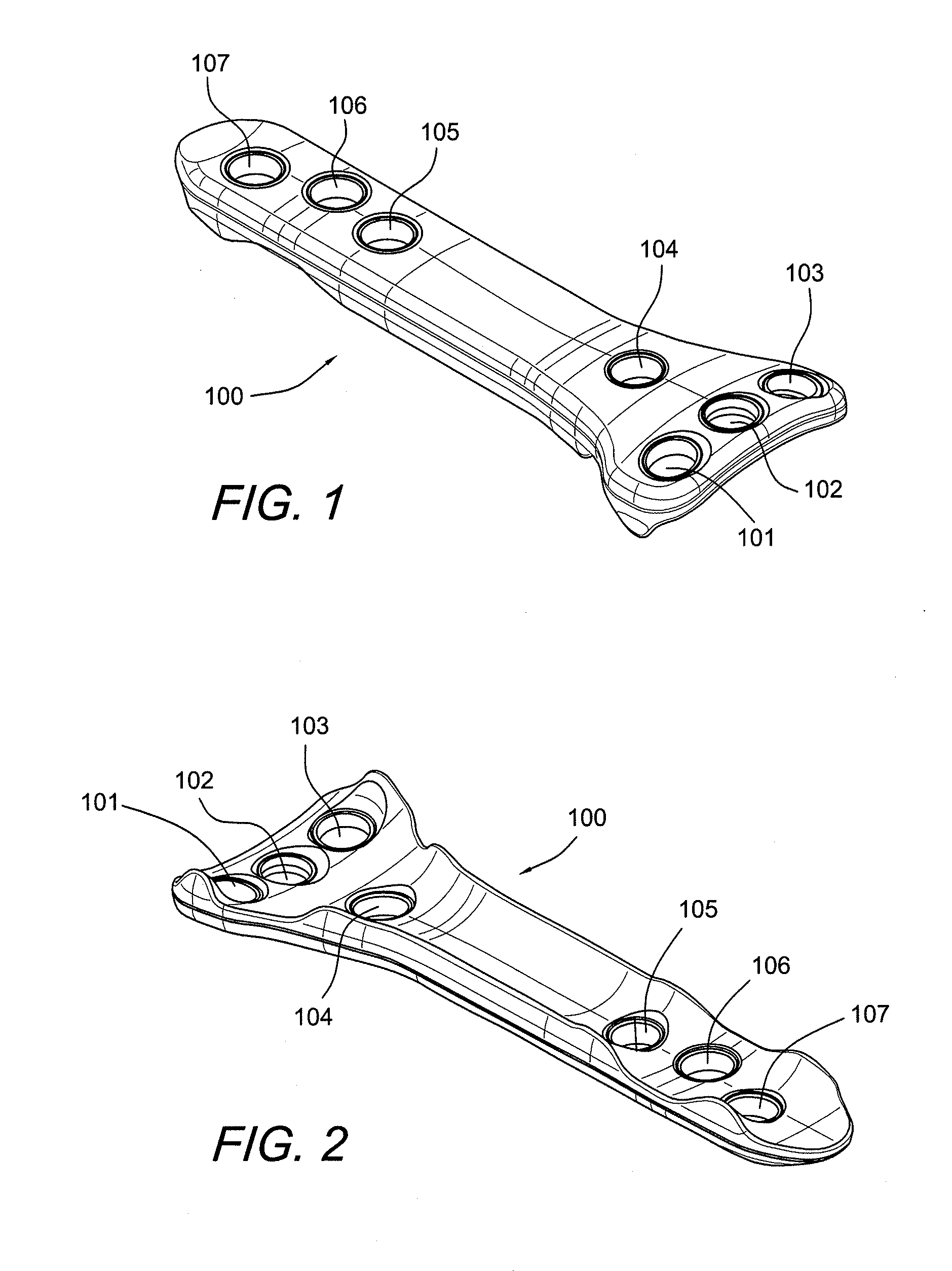 Carbon Fiber Reinforced Peek Bone Plate With Titanium Fixation Screws