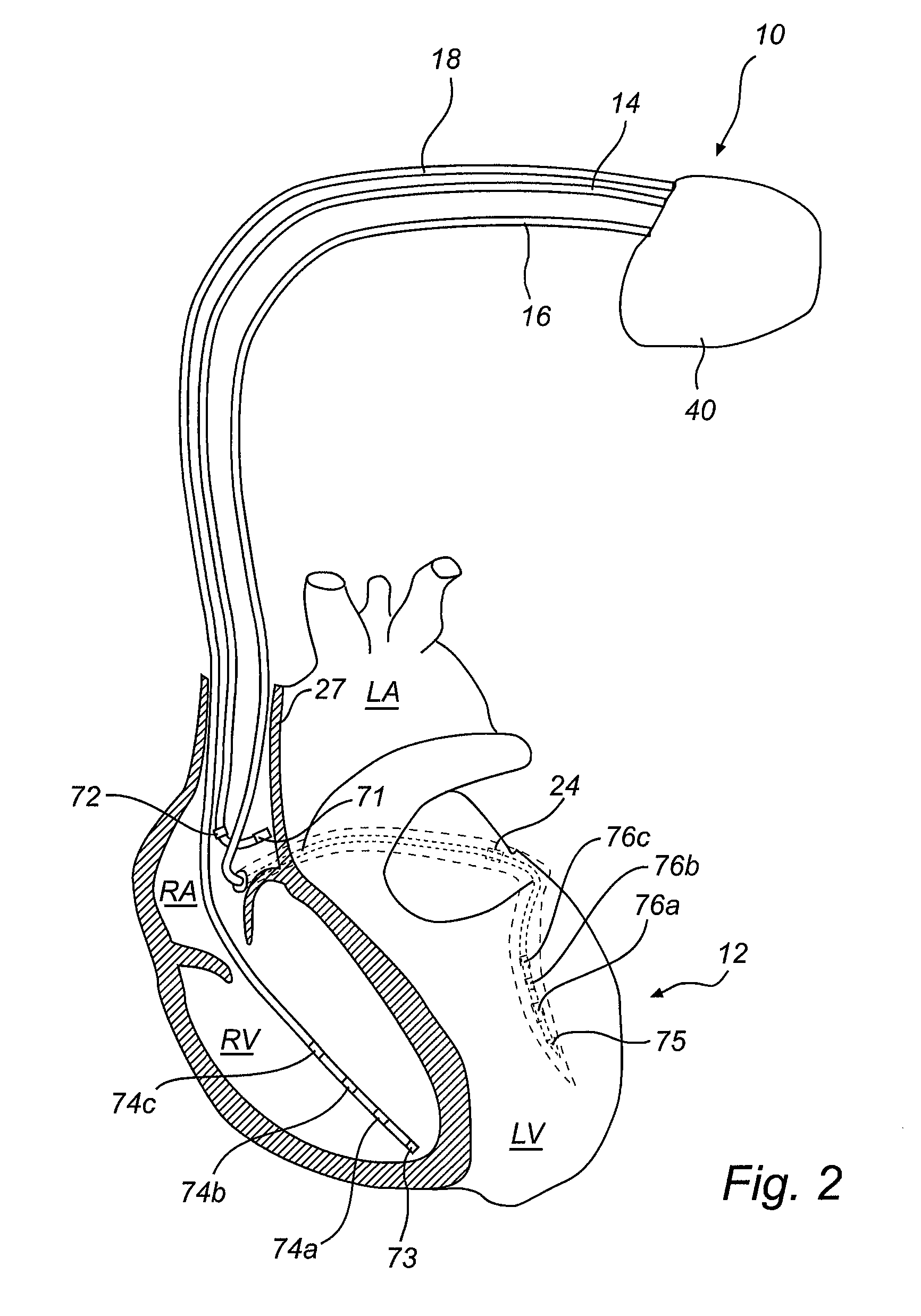 Detection and reduction of phrenic nerve stimulation