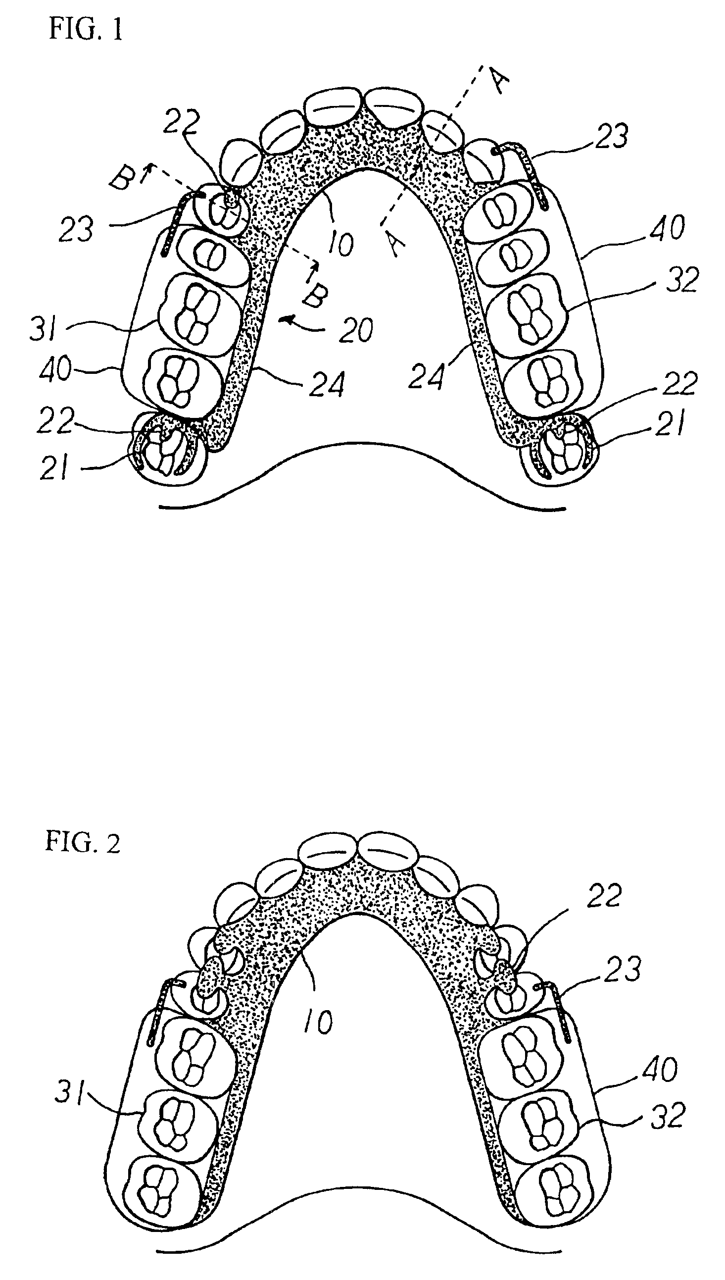 Removal partial denture free of palatal bar or lingual bar