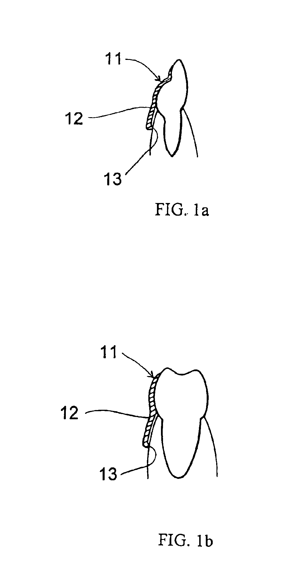 Removal partial denture free of palatal bar or lingual bar