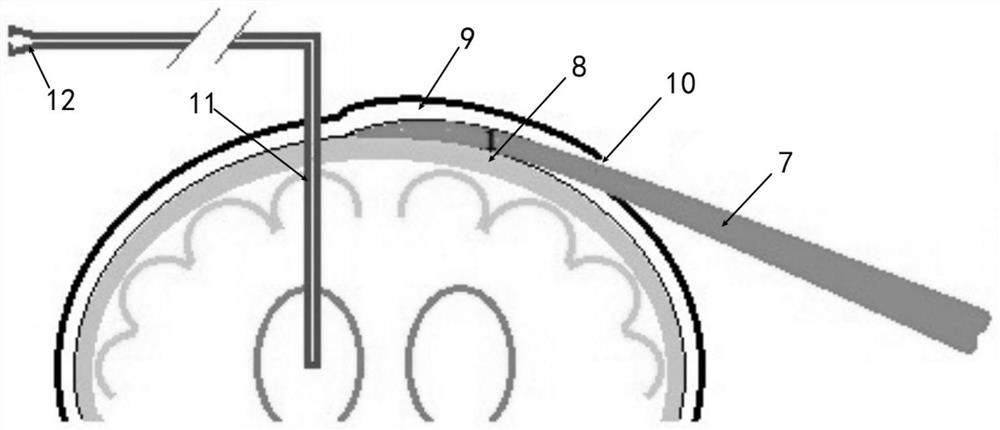 A cranial drainage tube subtly implanted device