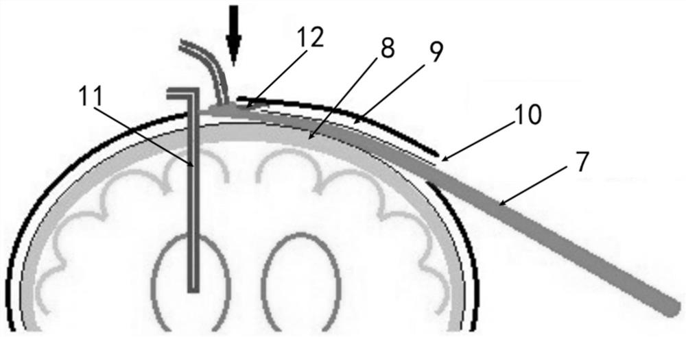 A cranial drainage tube subtly implanted device