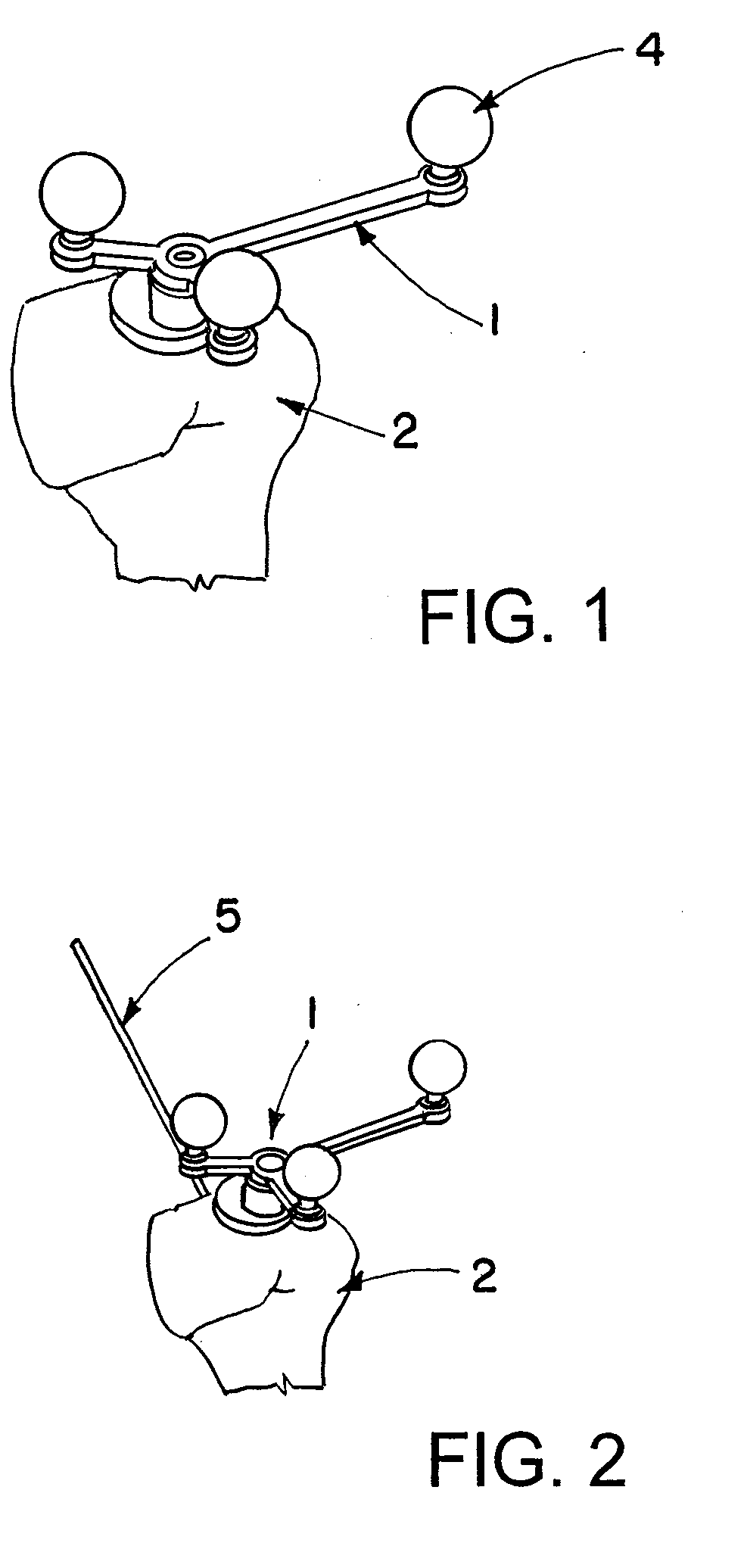 System for navigation-assisted shoulder operations and navigation method for positioning navigated treatment apparatuses with respect to a bone