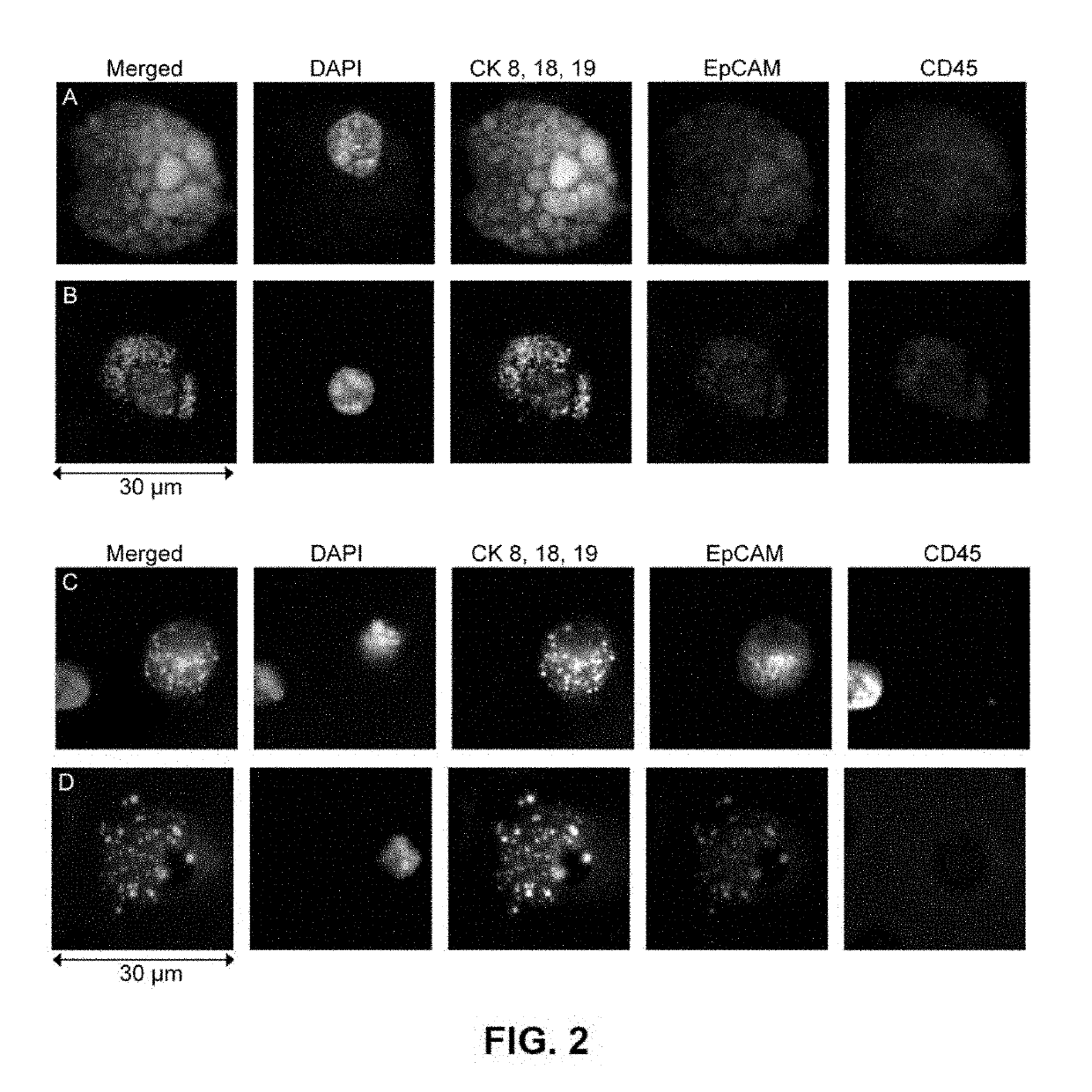 Capture, identification and use of a new biomarker of solid tumors in body fluids