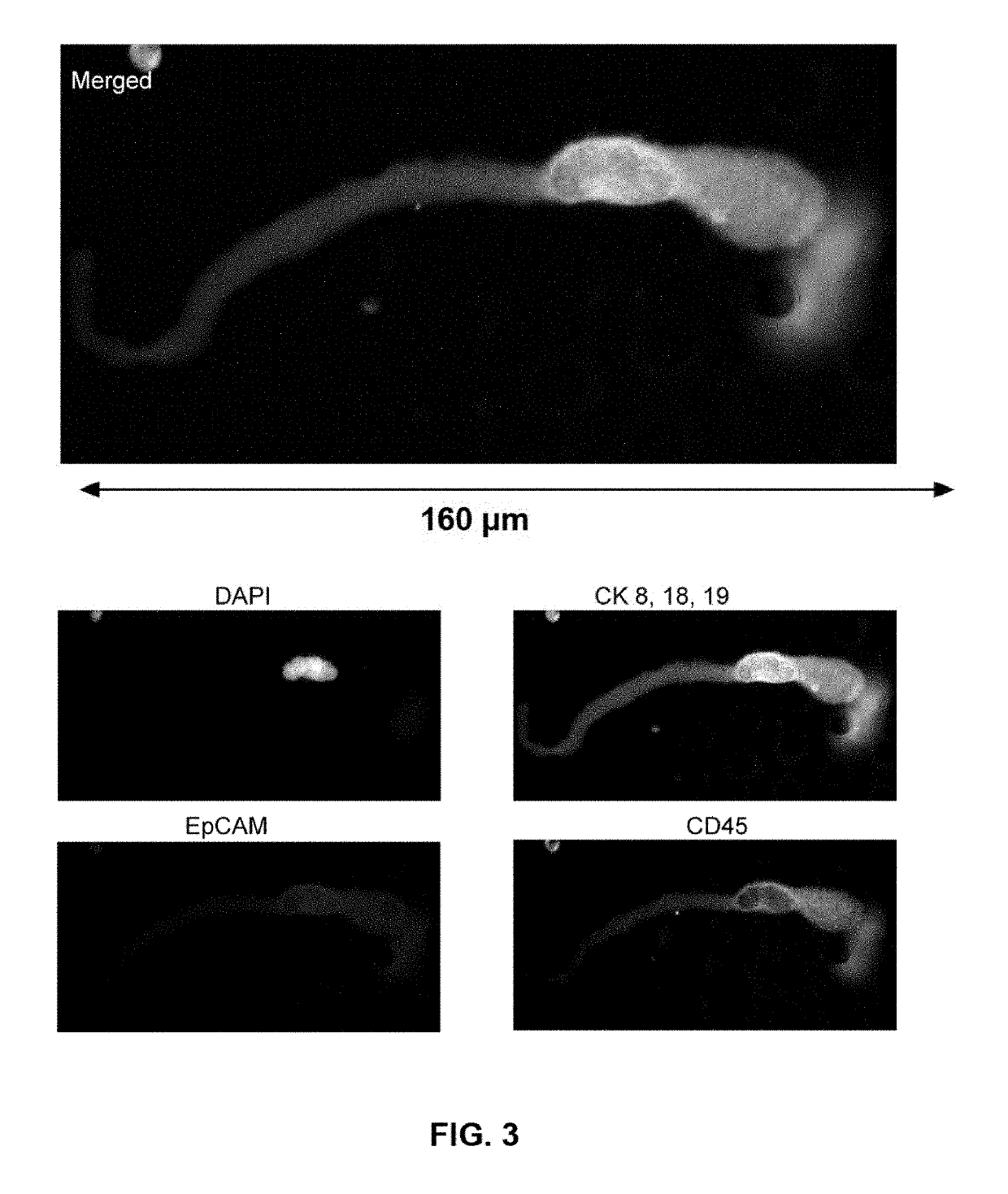 Capture, identification and use of a new biomarker of solid tumors in body fluids