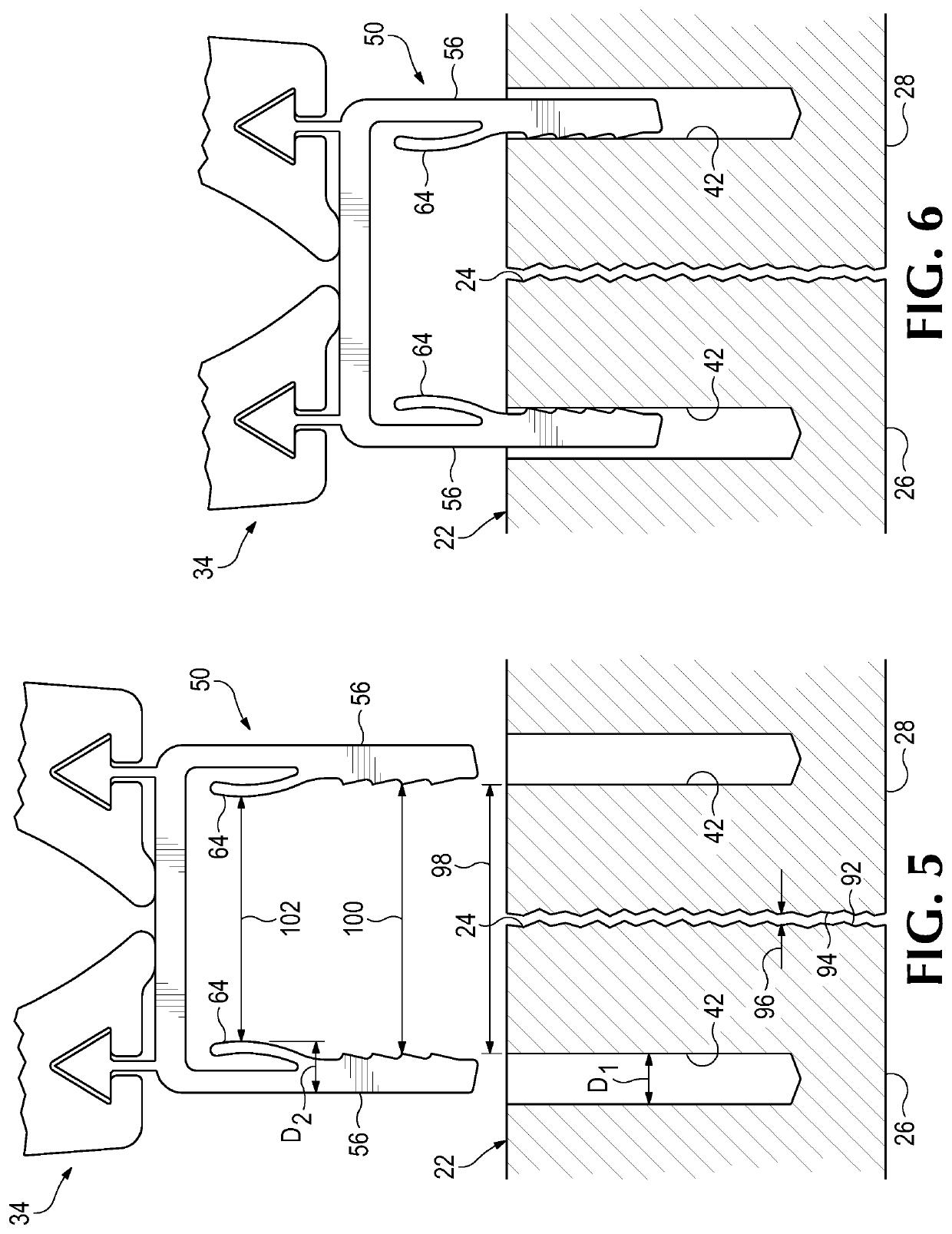 Bone clip with resilient arm for proximal compression