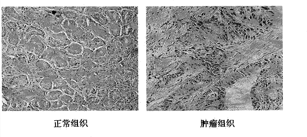 Hybrid tumor generating anti-AMP-18 (Antrum Mucosalprotein-18) monoclonal antibody as well as anti-AMP-18 monoclonal antibody and application thereof in gastric carcinoma detection