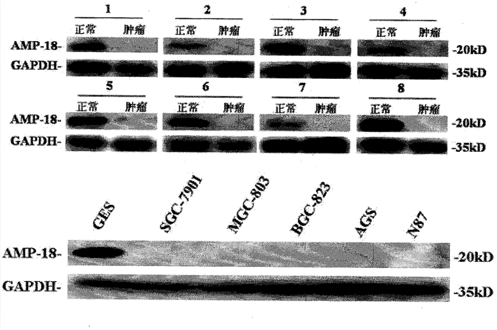 Hybrid tumor generating anti-AMP-18 (Antrum Mucosalprotein-18) monoclonal antibody as well as anti-AMP-18 monoclonal antibody and application thereof in gastric carcinoma detection