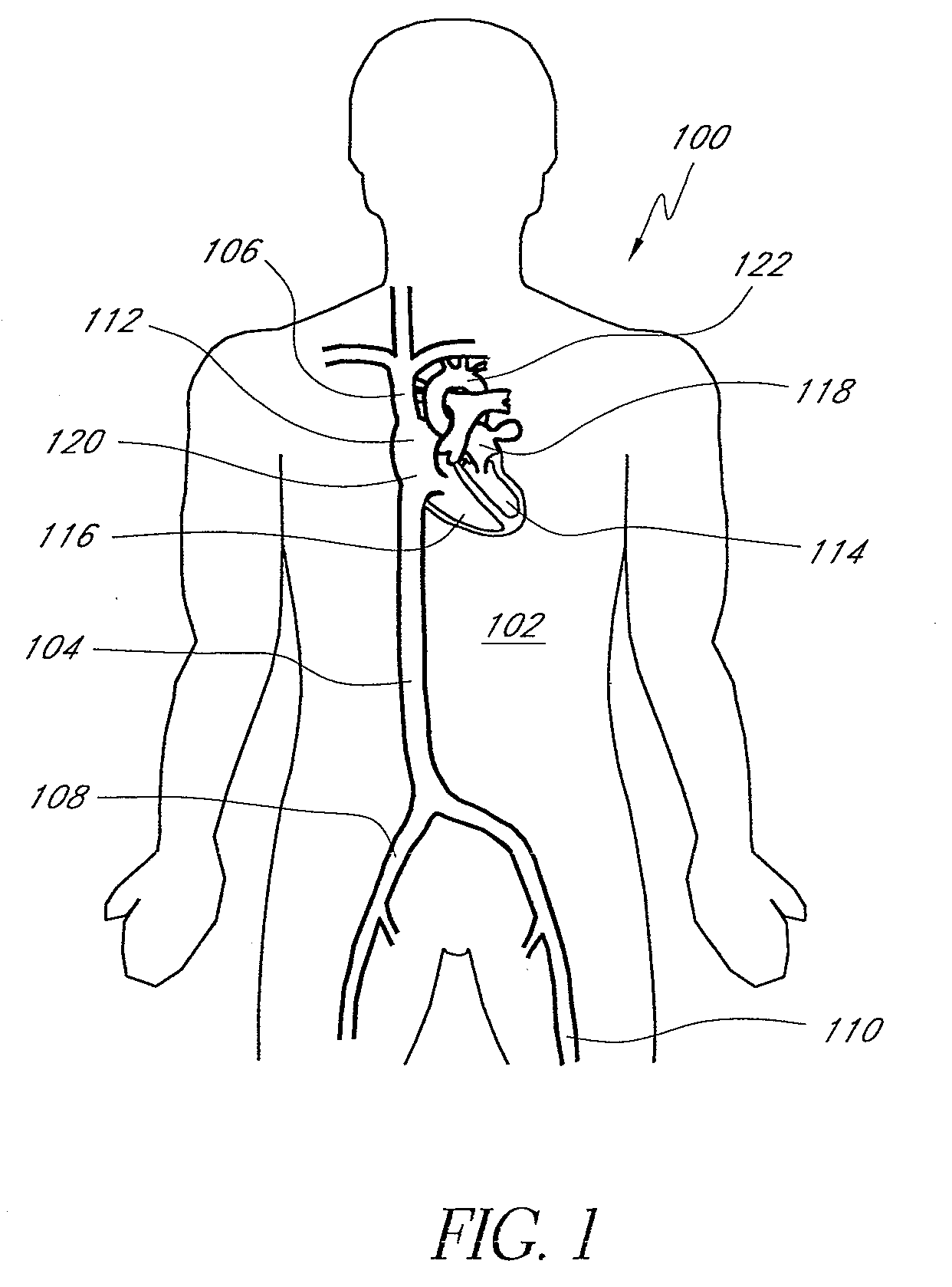 Endovascular catheter air block