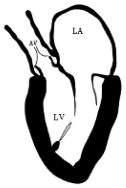 Artificial chordal implantation system with gripping aid