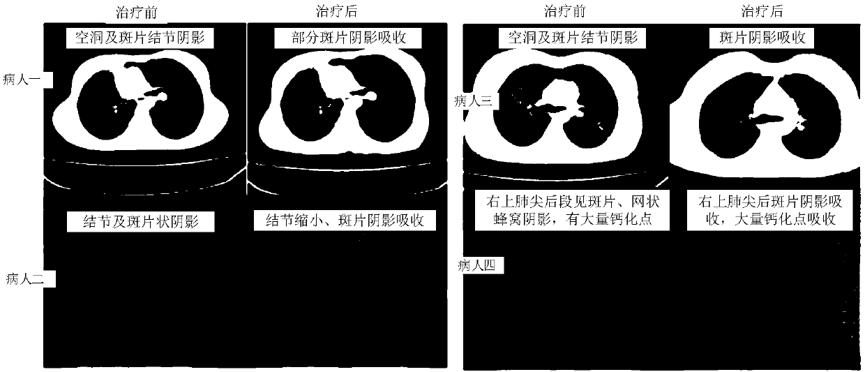 Novel biological agent for treating drug resistant tuberculosis and preparation method thereof