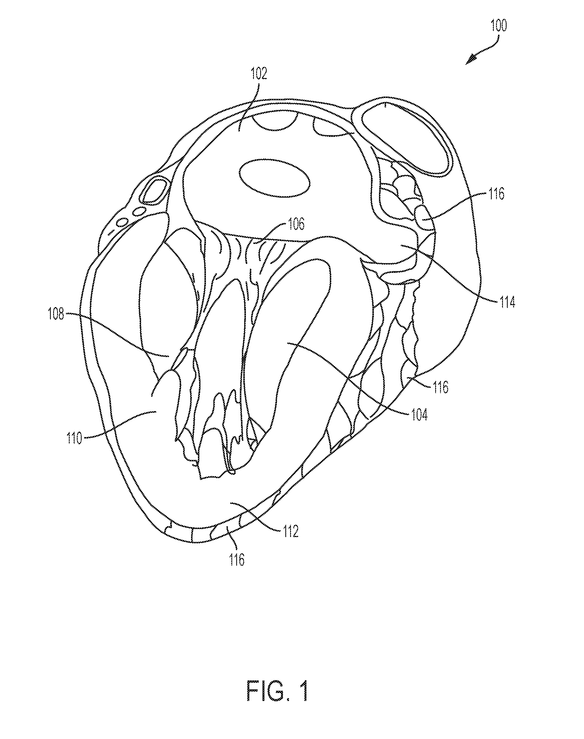 Devices and methods for left atrial appendage closure