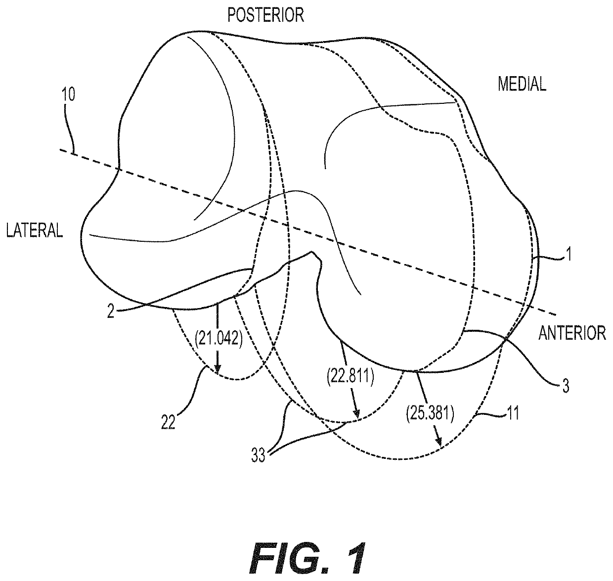 Total ankle replacement with anatomically fitted talar component