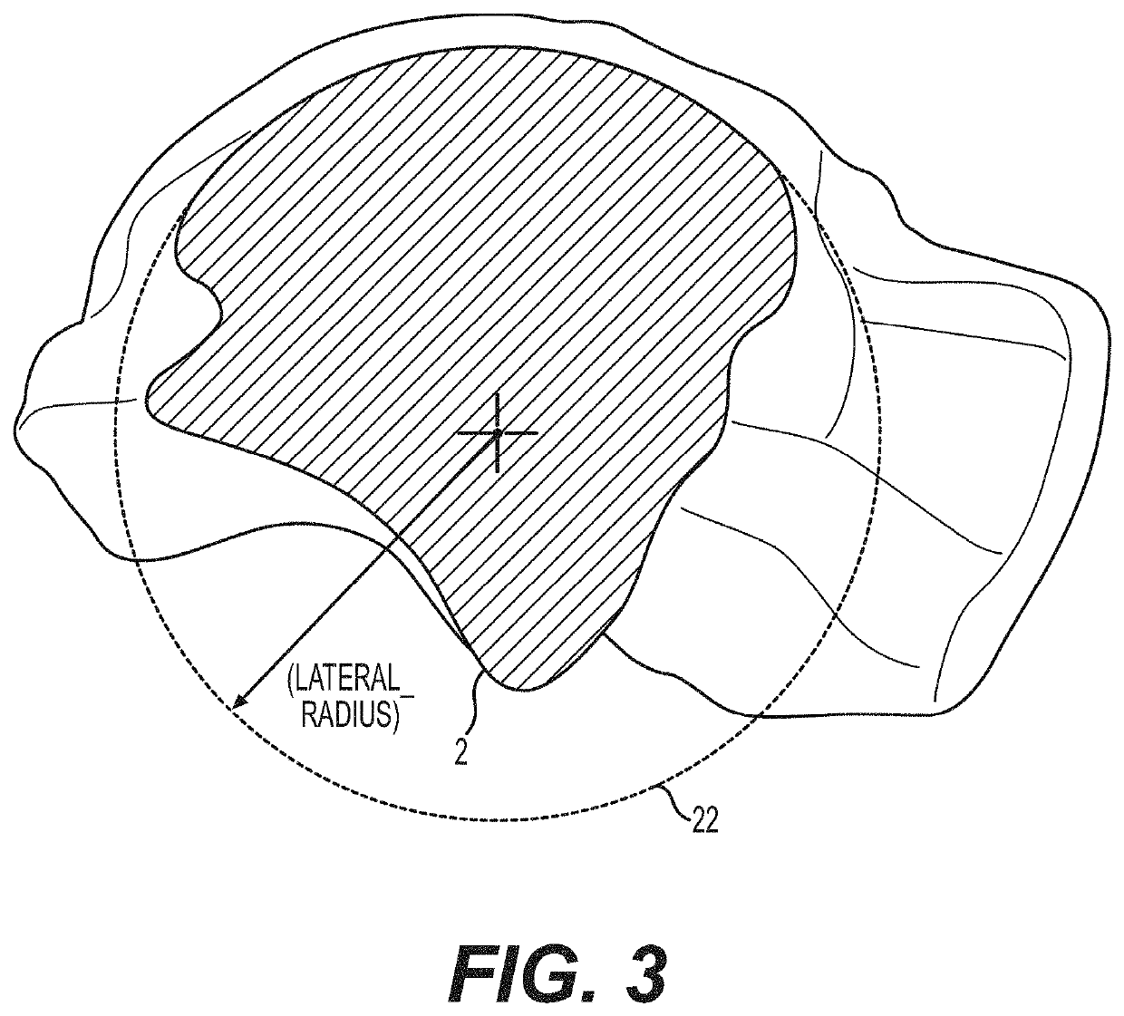 Total ankle replacement with anatomically fitted talar component