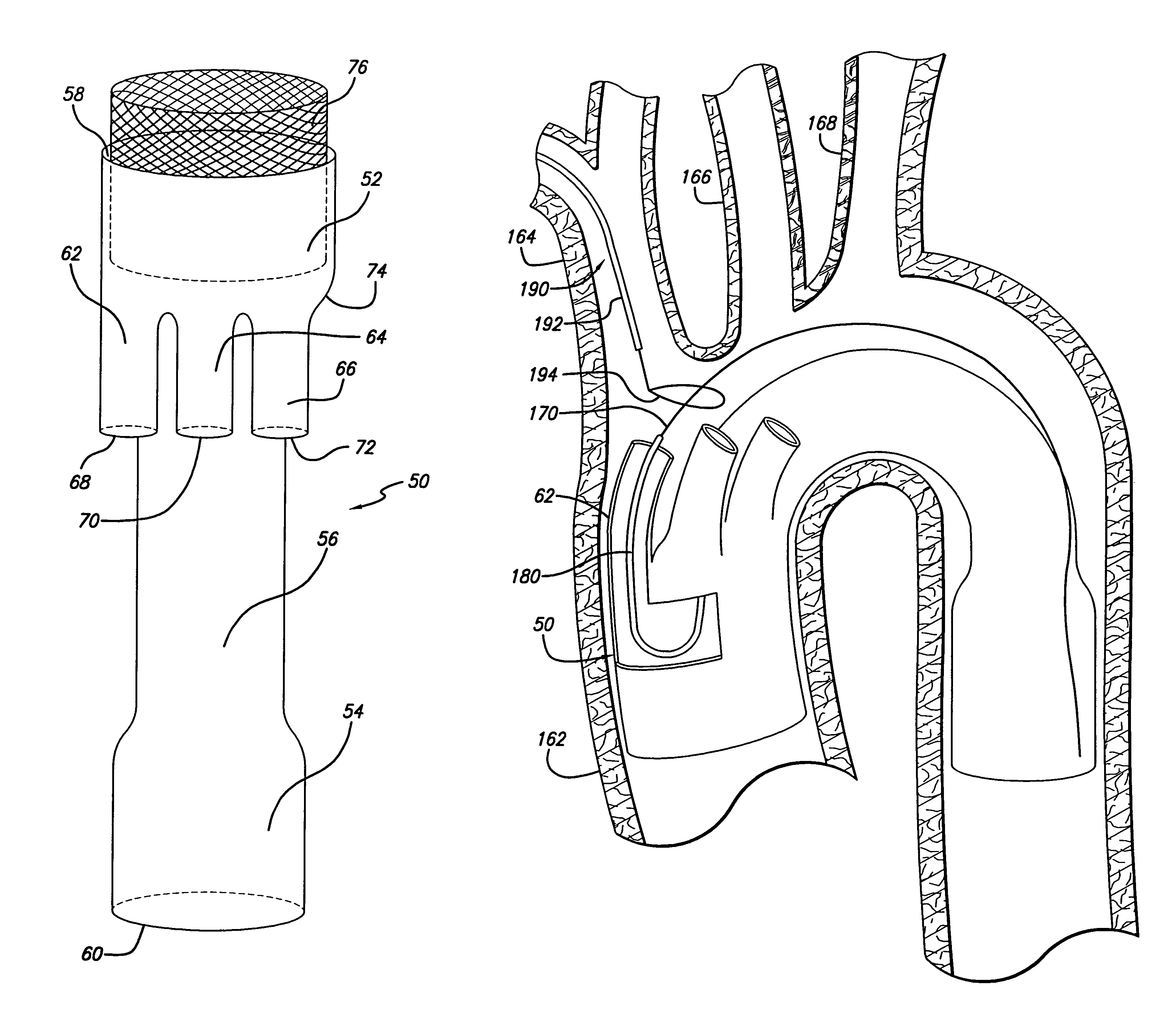 Modular grafting system and method