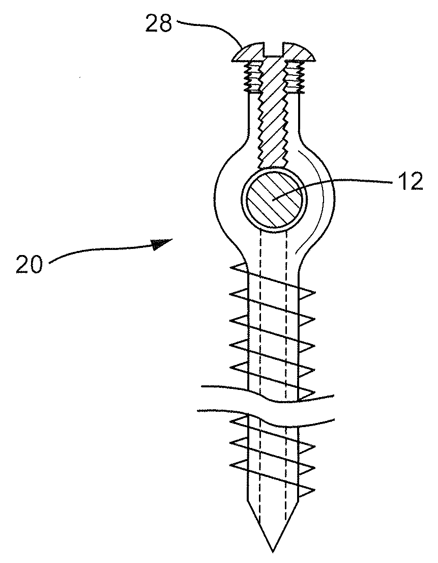 Transfacet-Pedicle Locking Screw Fixation of Lumbar Motion Segment