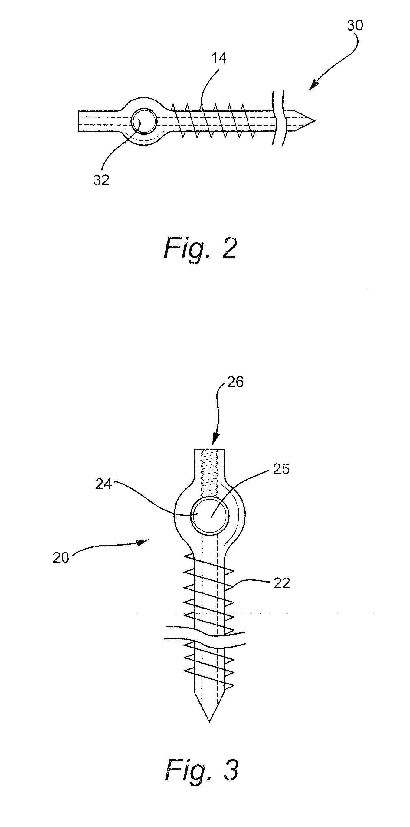 Transfacet-Pedicle Locking Screw Fixation of Lumbar Motion Segment