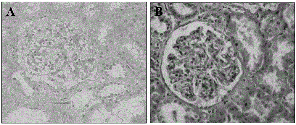 Analytical method and application of differentially expressed miRNAs in renal tissues of primary IGA nephropathy