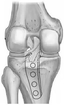 Medical internal fixator for posterior cruciate ligament lower dead center avulsion fracture