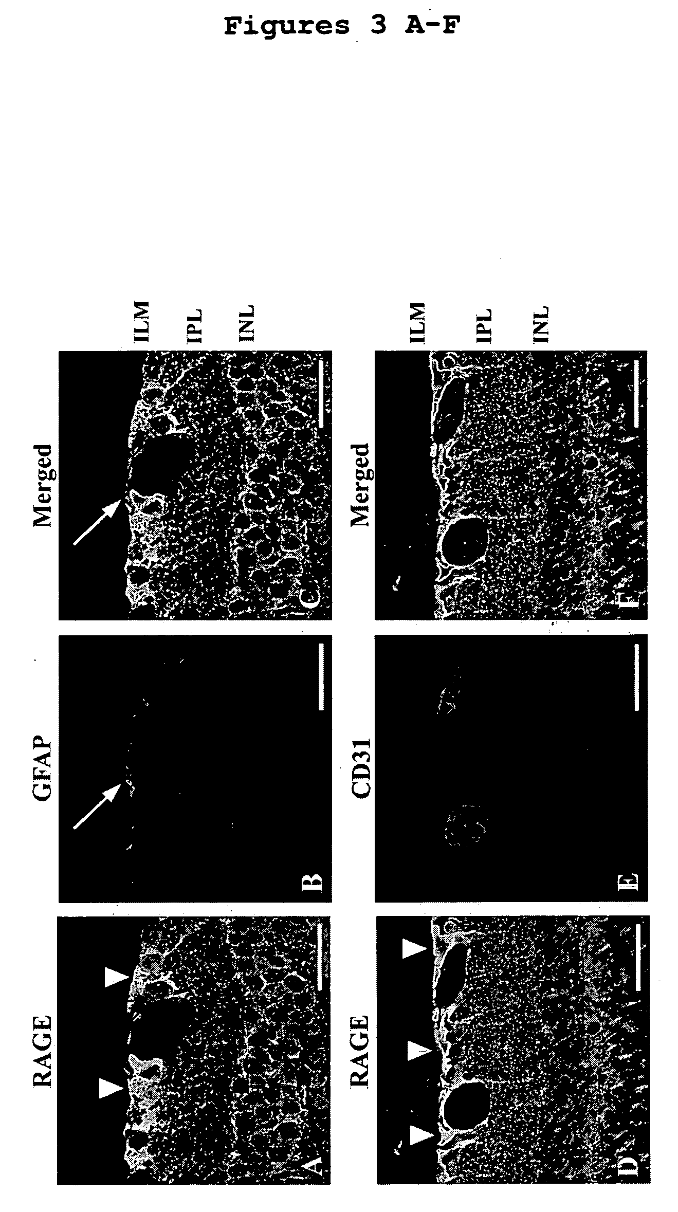 Rage-related methods for treating and preventing diabetic retinopathy