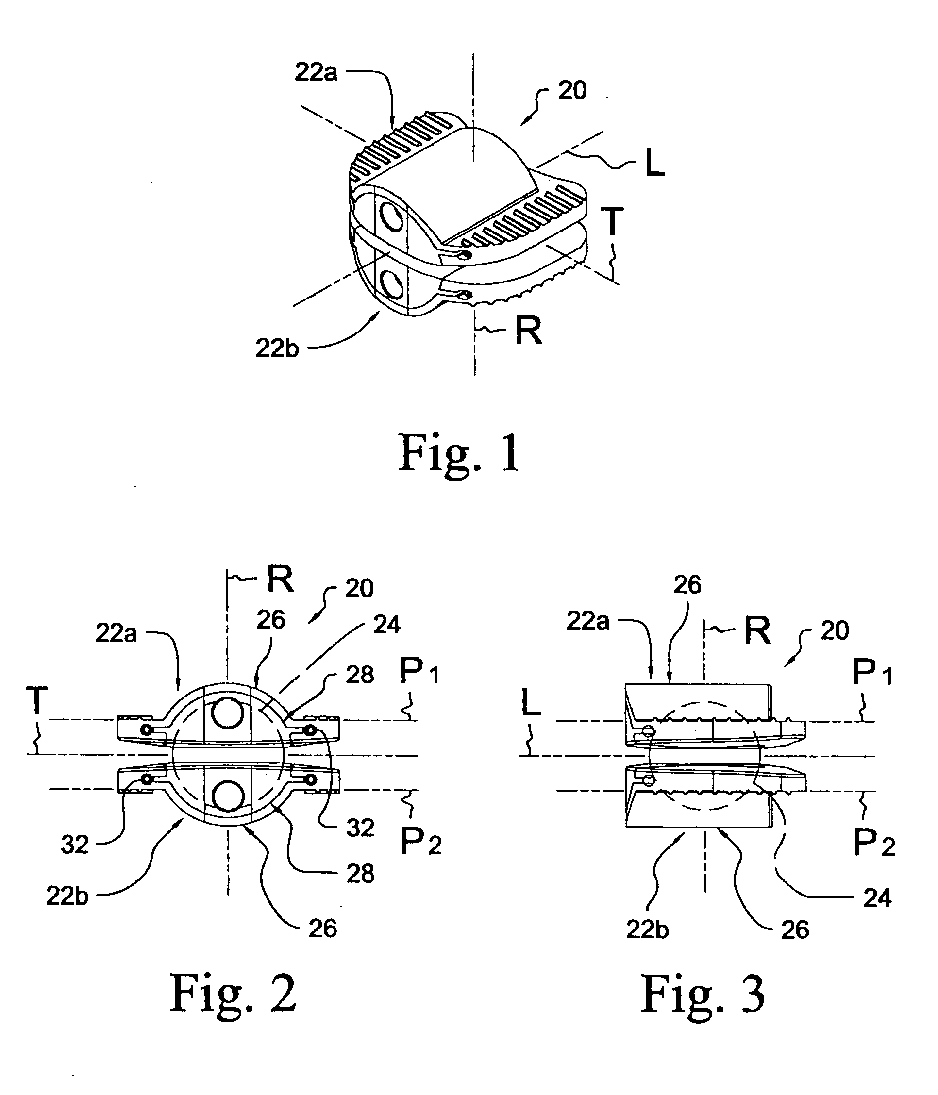 Articular disc prosthesis and method for implanting the same