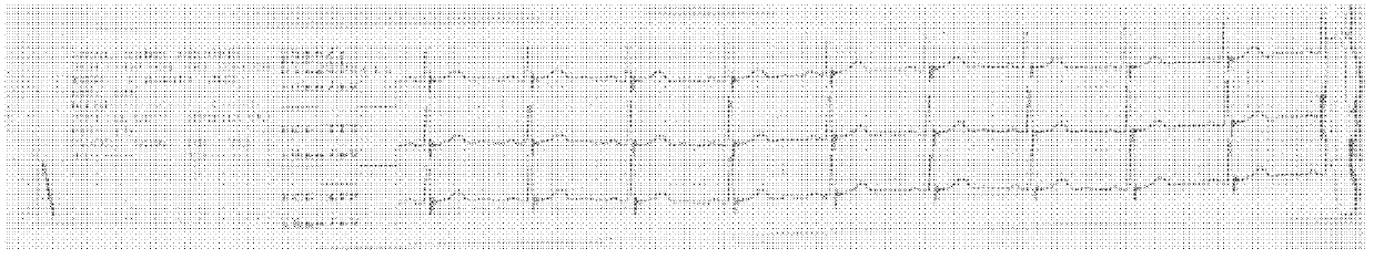 Cell excitation treatment instrument for cardiovascular diseases